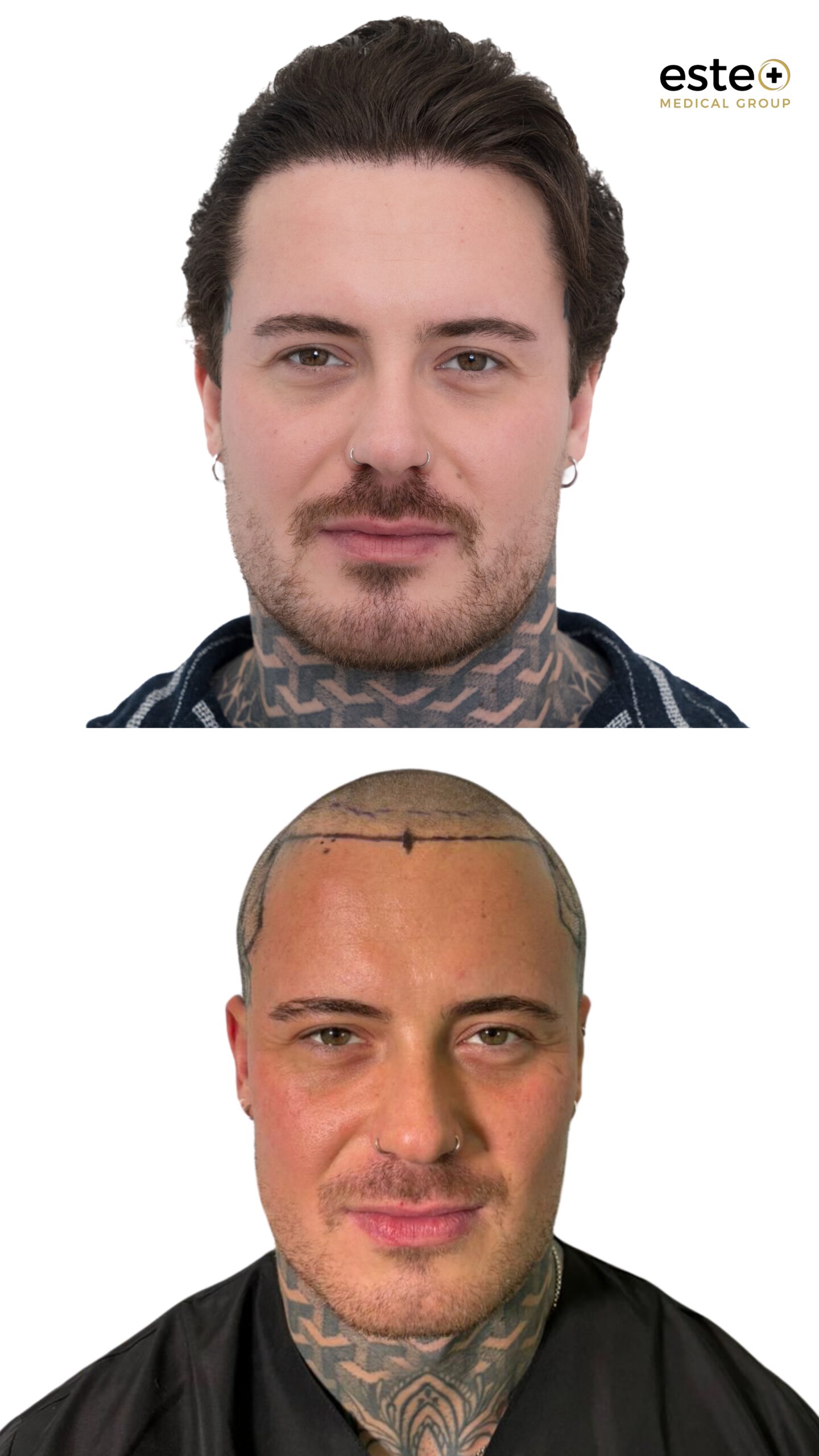 hair transplant before after results dubai
