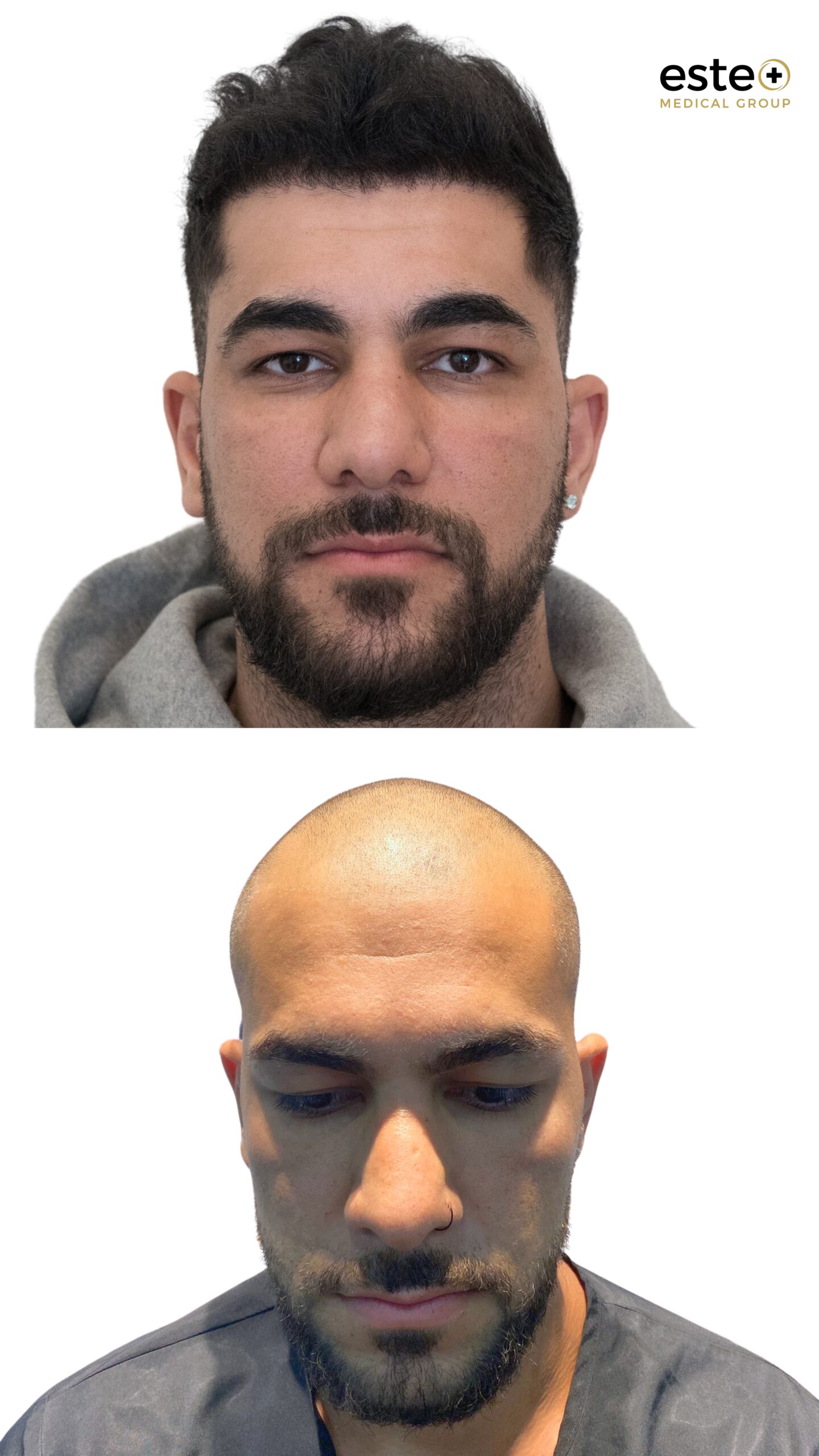 Before and after hair transplant for receding hairline at Este Medical Group Dubai