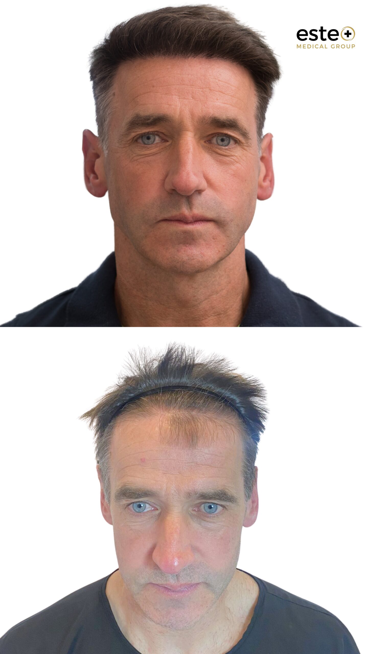 Hair transplant Dubai patient results showing restored hair density