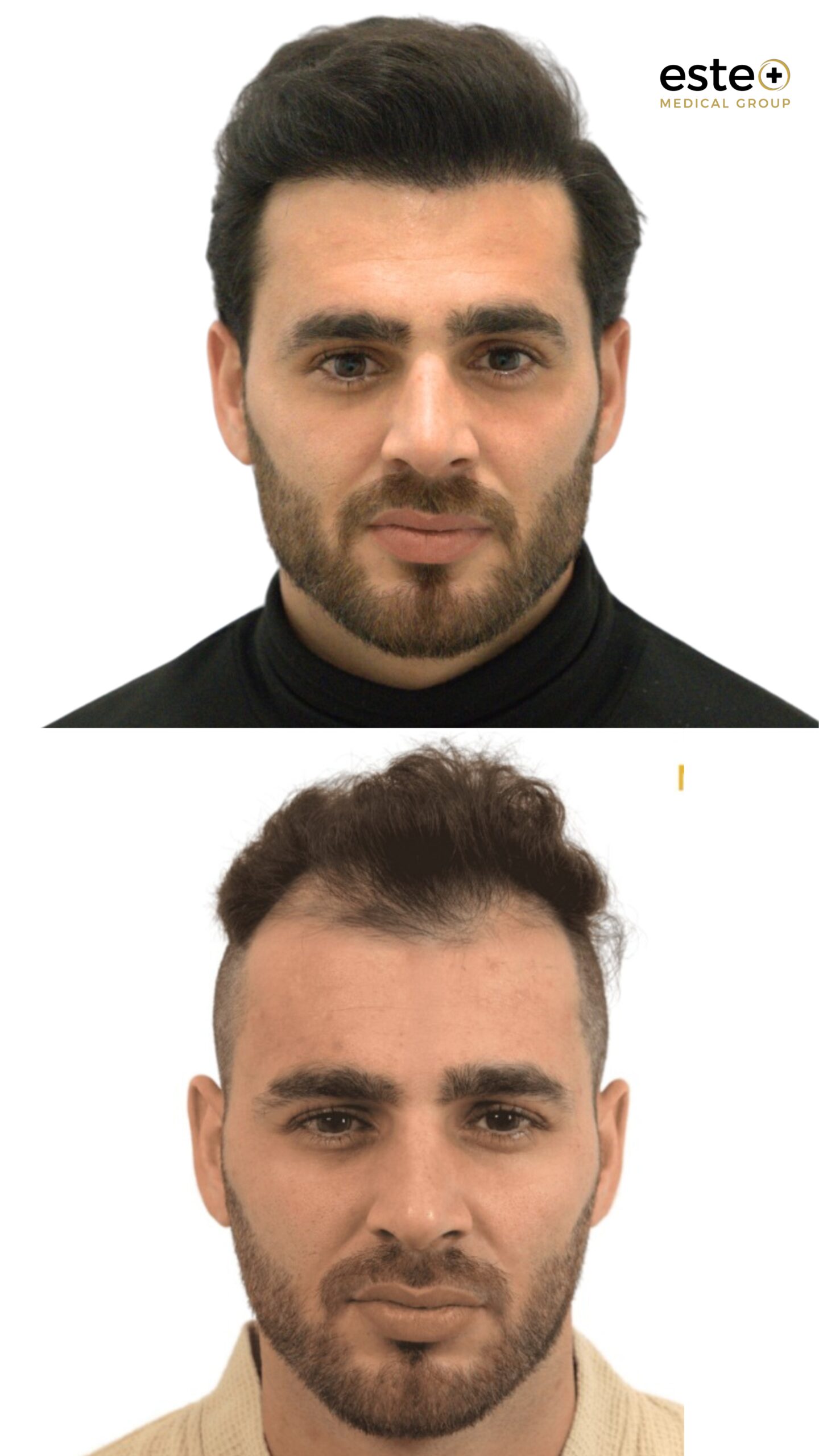 hair transplant before after results dubai