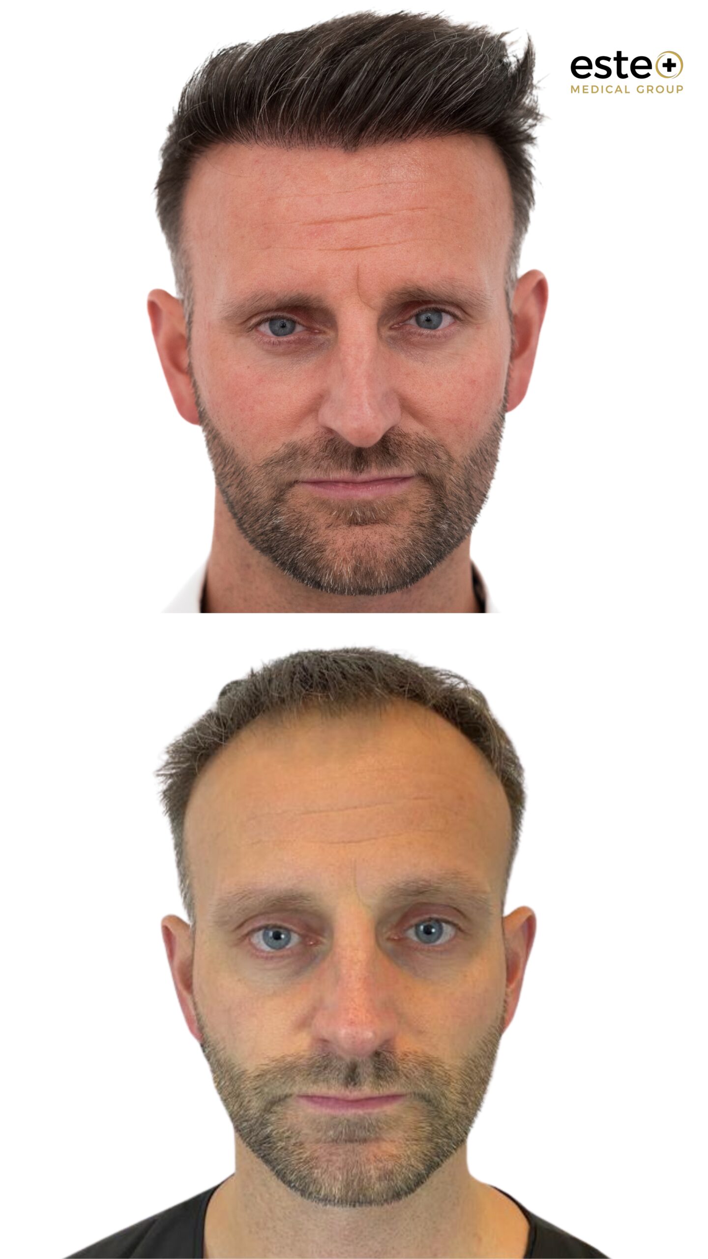 Male pattern baldness before and after DHI hair transplant in Dubai