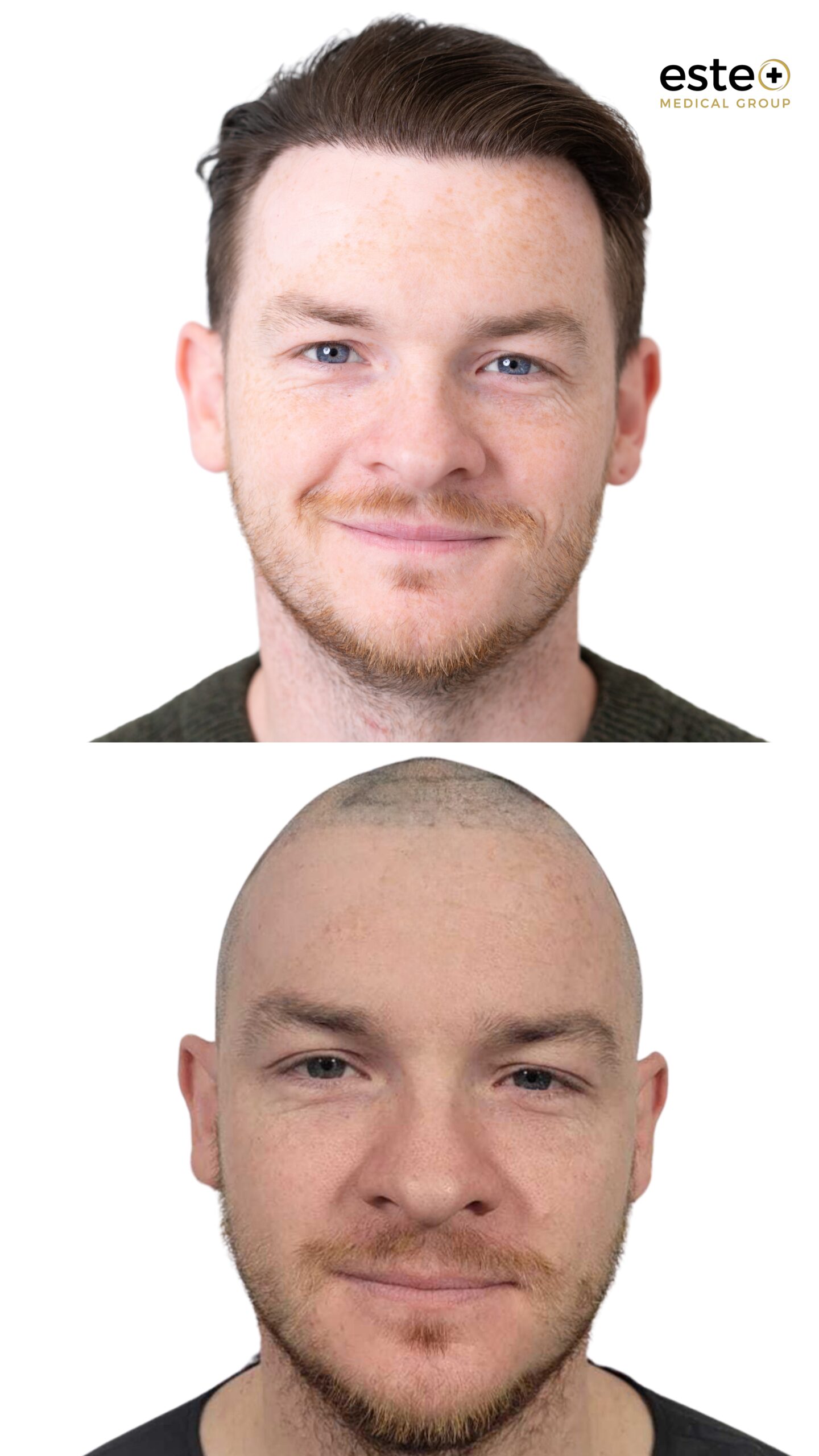 Natural hairline design after hair transplant treatment in Dubai clinic