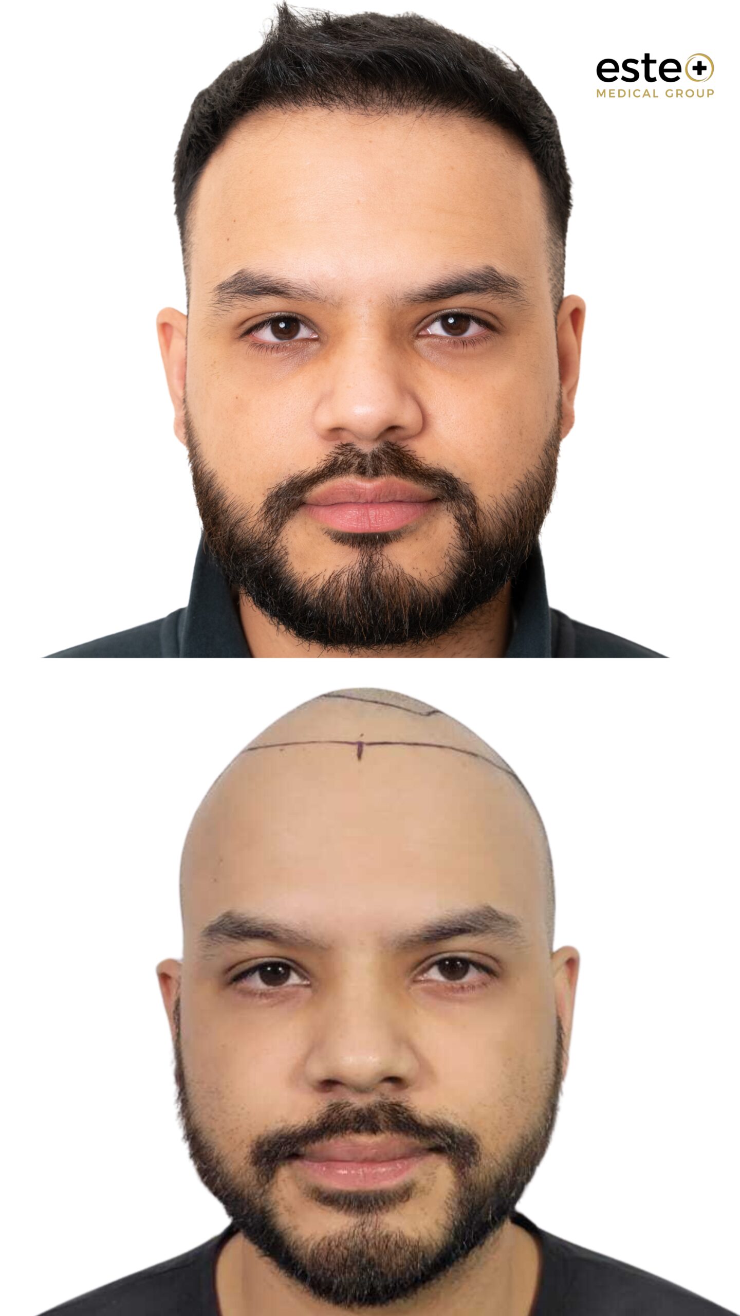 Hair transplant before and after results for thinning hair at Este Medical Group Dubai
