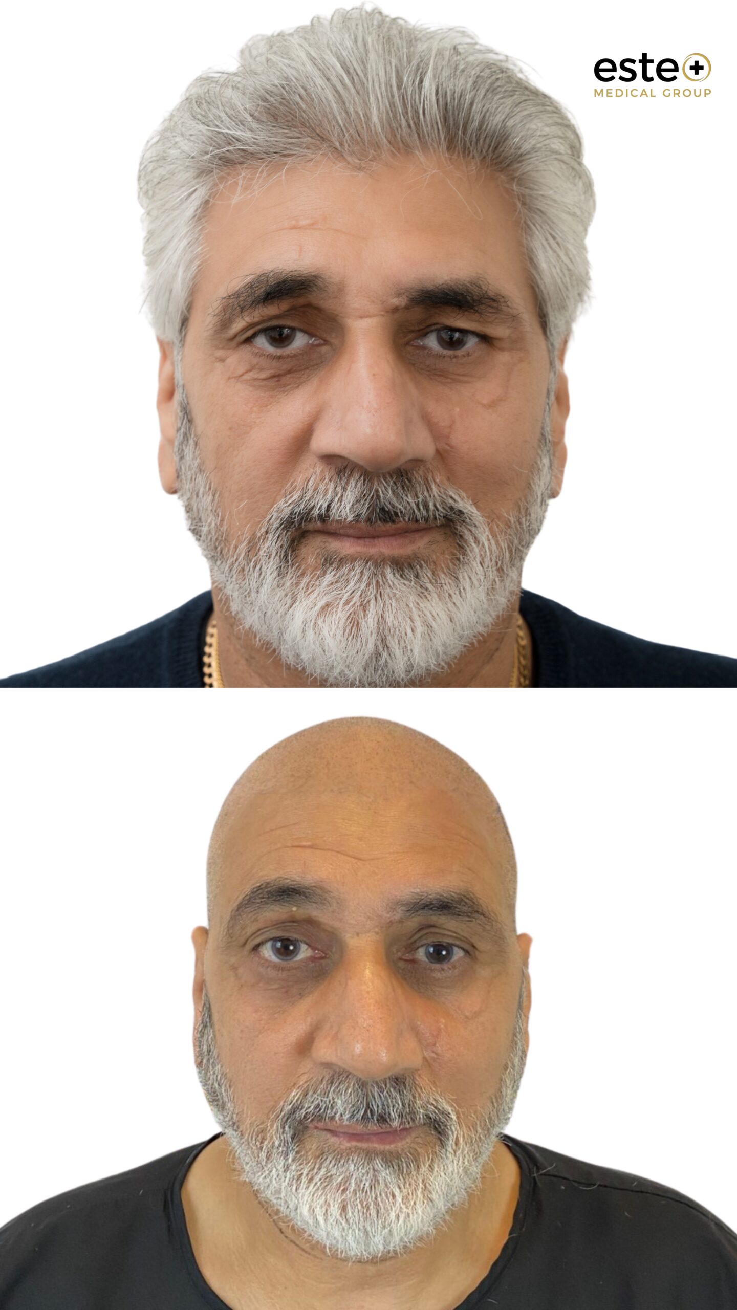 DHI hair transplant transformation showing fuller hair and improved hairline