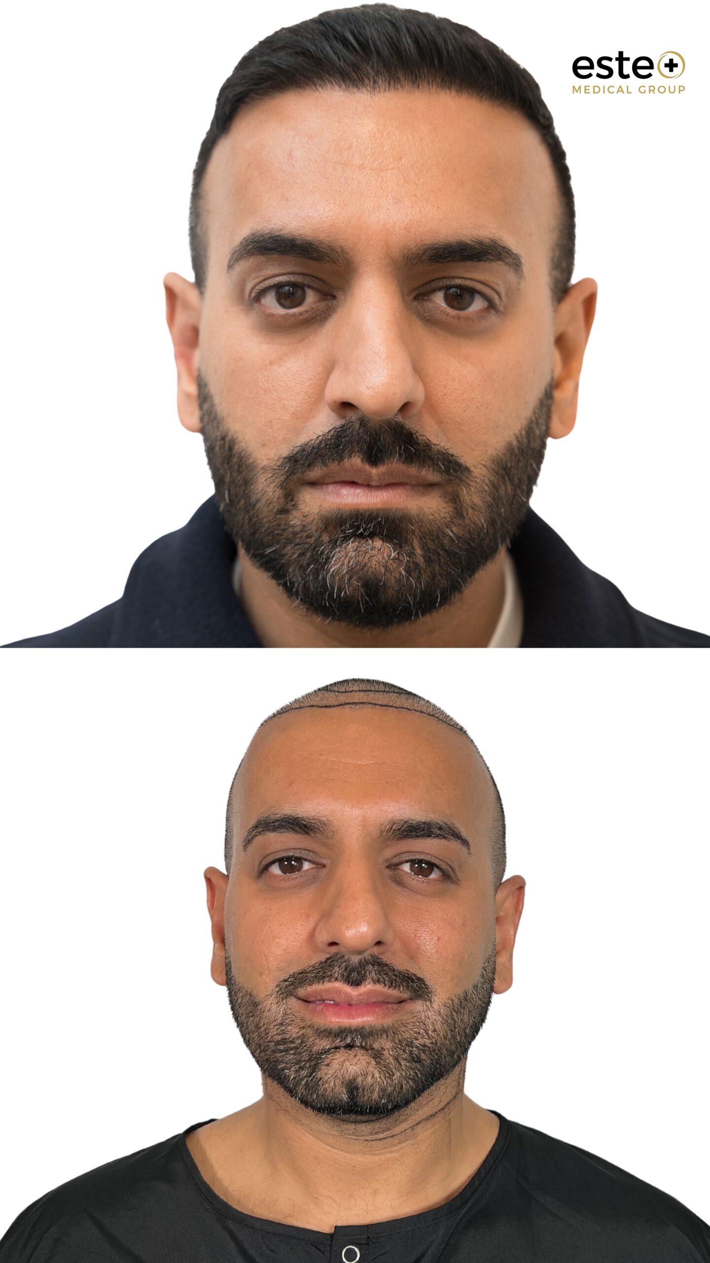 Hair restoration results Dubai clinic before and after treatment
