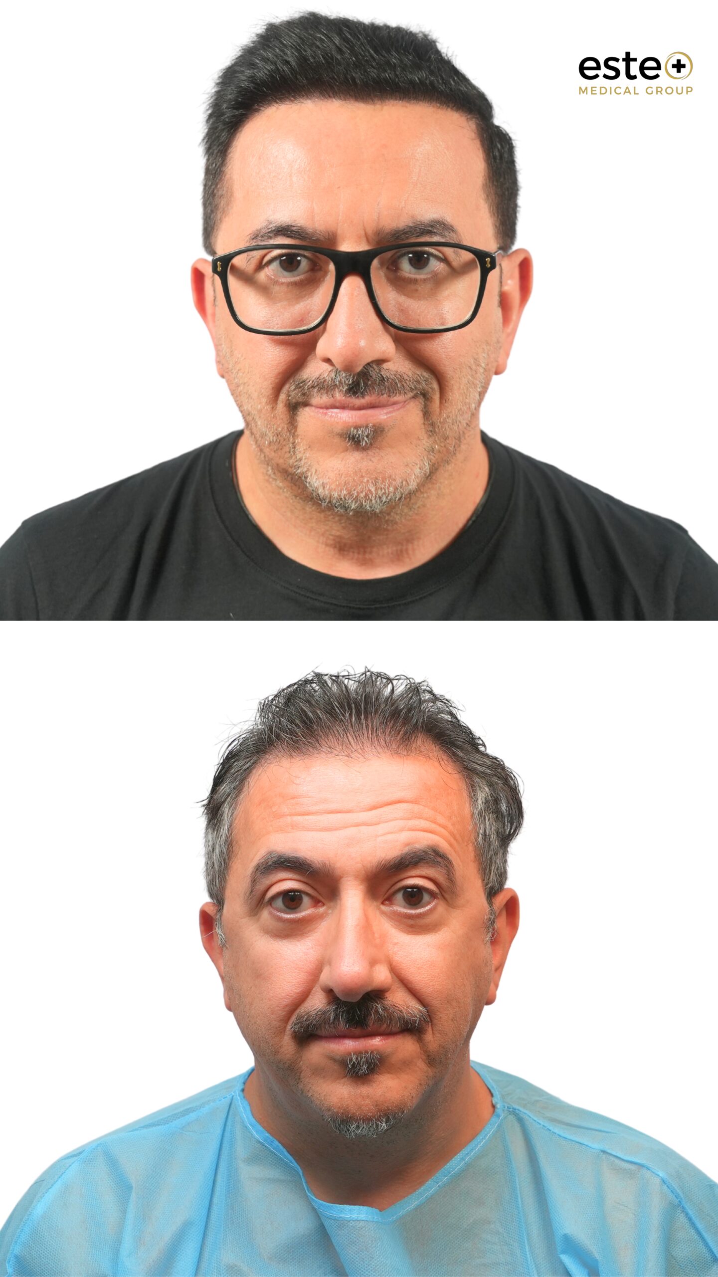 DHI hair transplant results in Dubai with improved hair thickness and coverage