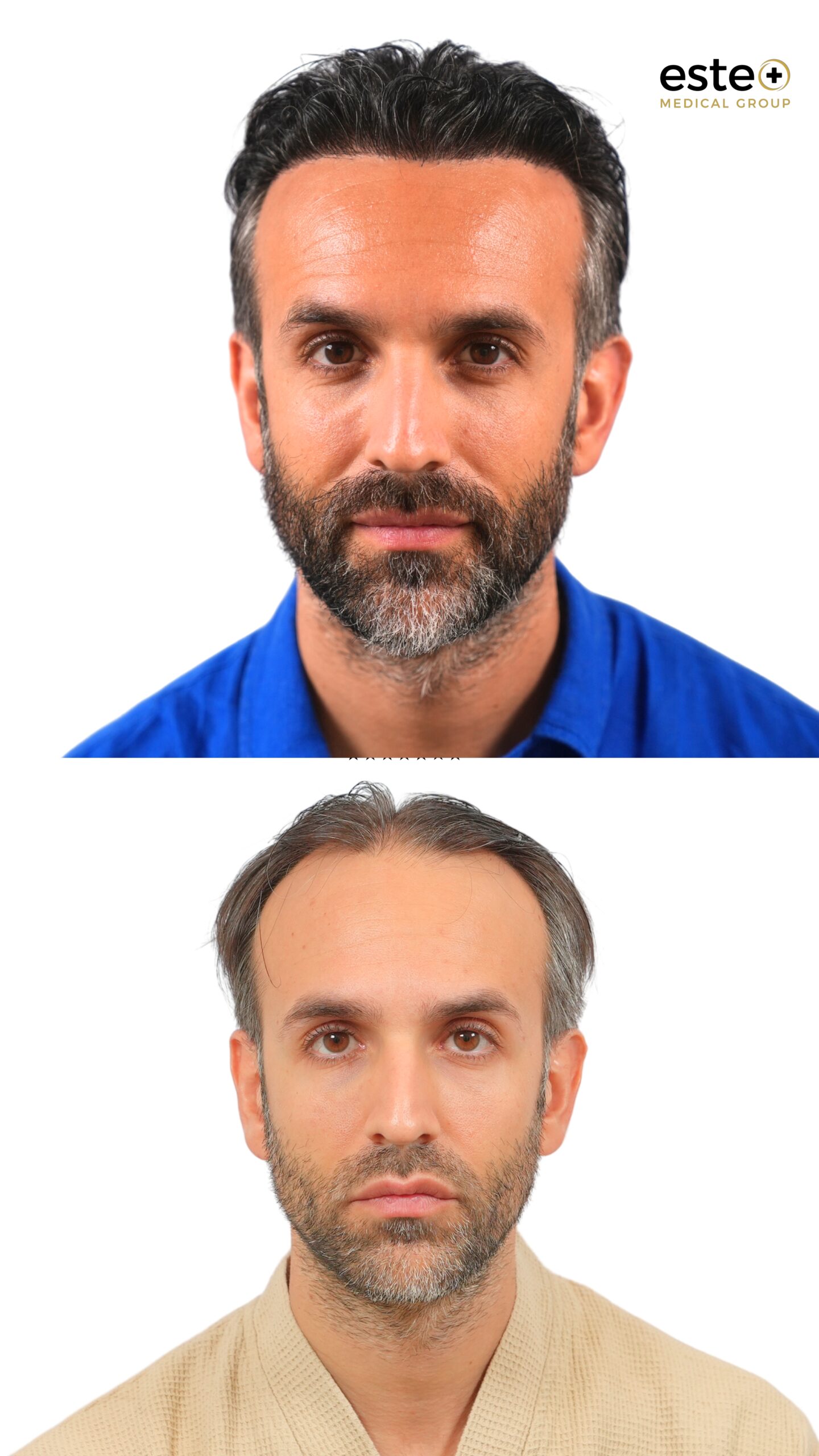 Patient hair transplant journey showing hair growth results in Dubai