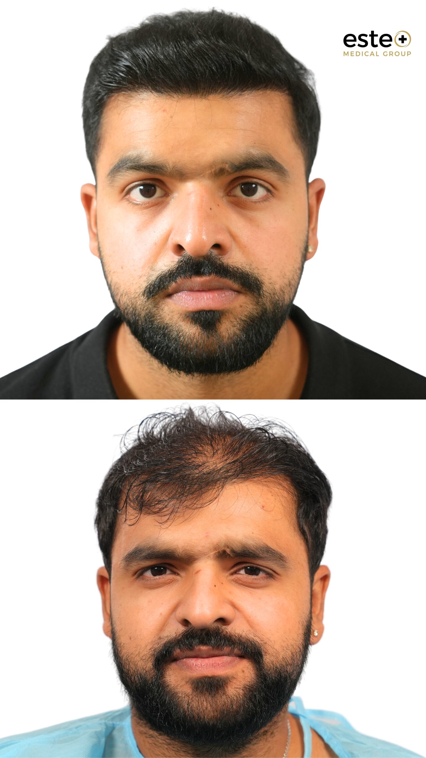 Hair transplant density improvement before and after DHI treatment in Dubai
