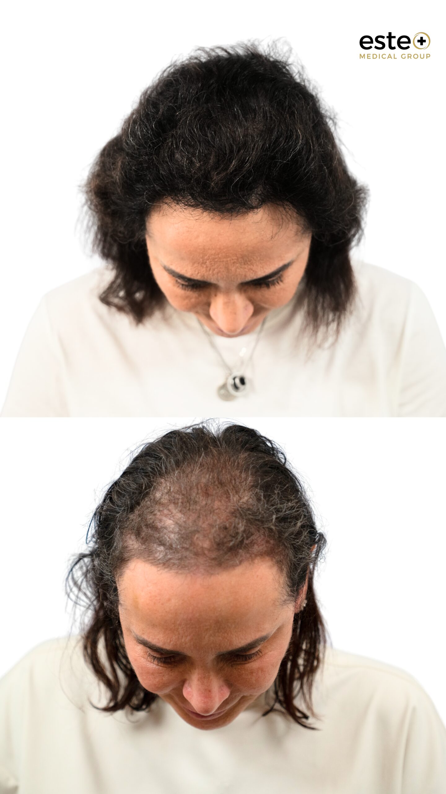 Hair transplant Dubai results showing natural hair growth after treatment