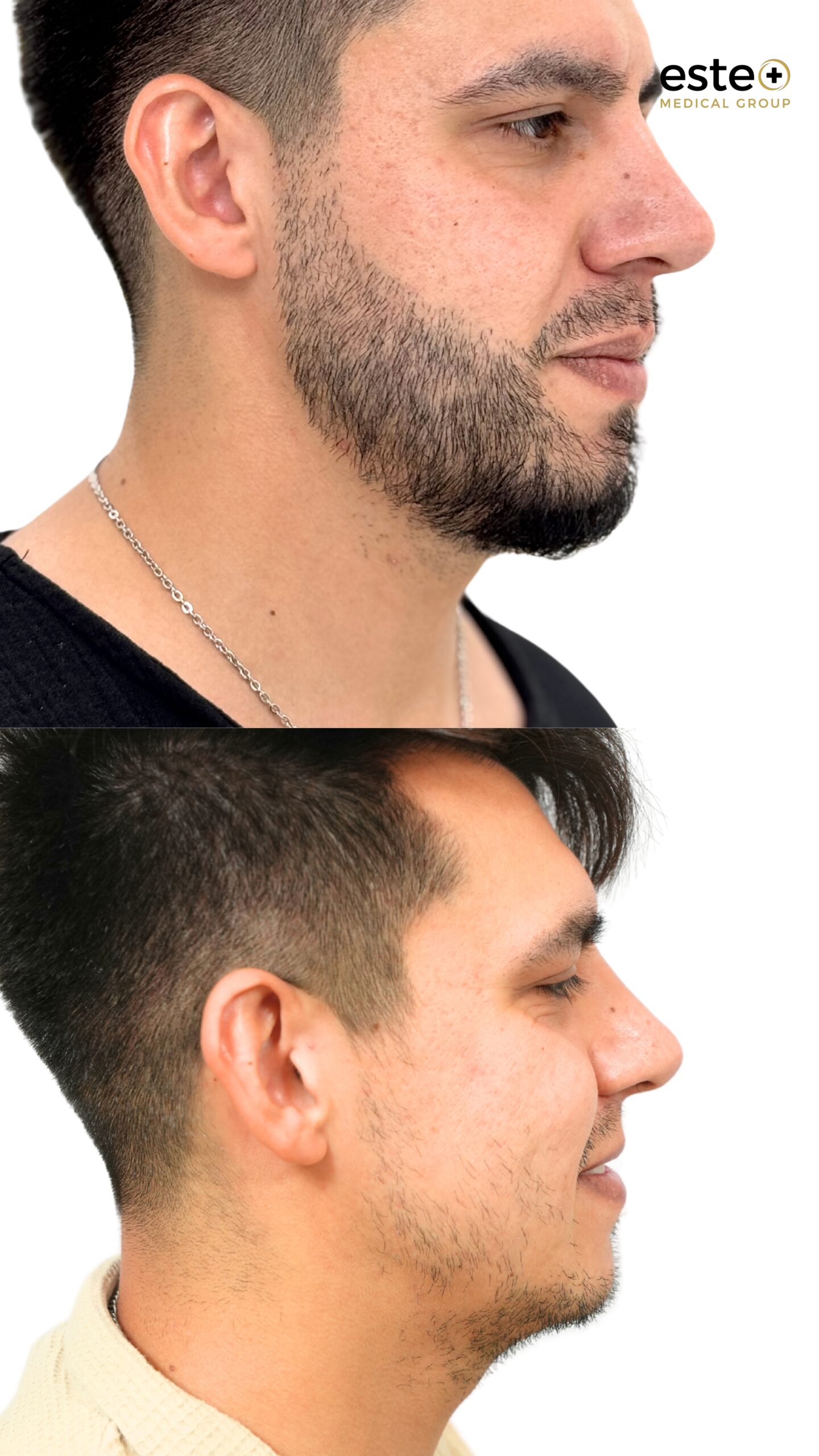 Hairline restoration before and after DHI hair transplant in Dubai