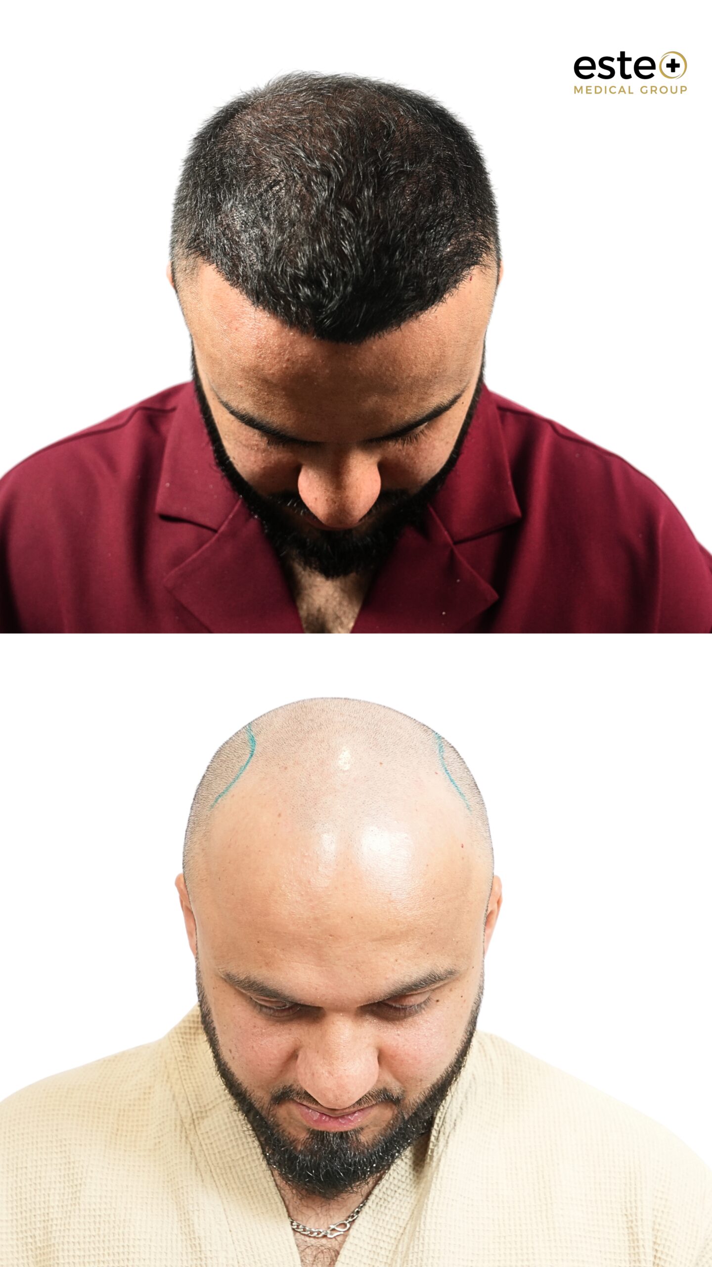 Before and after DHI hair transplant procedure with restored hairline