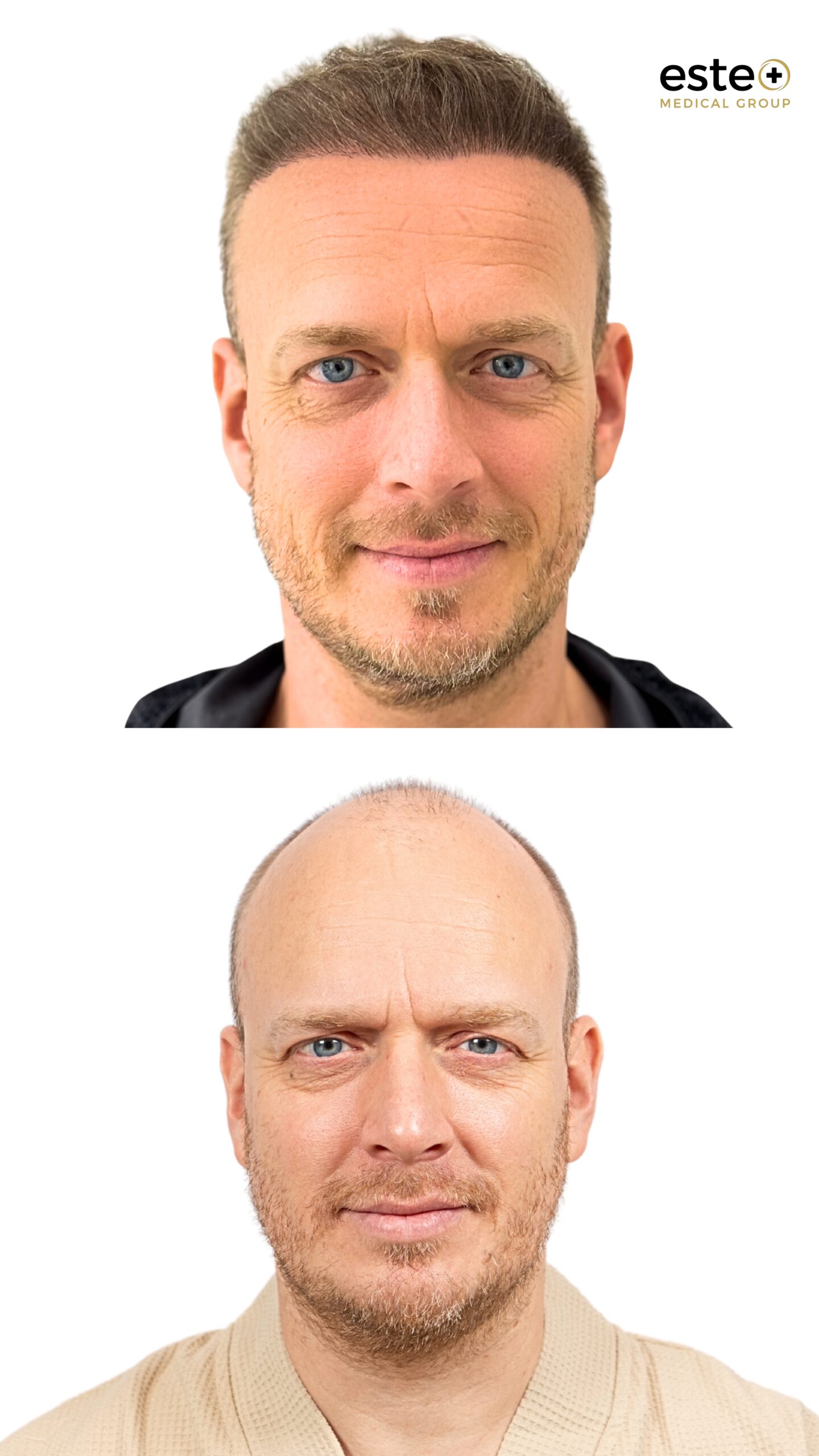 Hair transplant patient results improving thinning hair and hairline