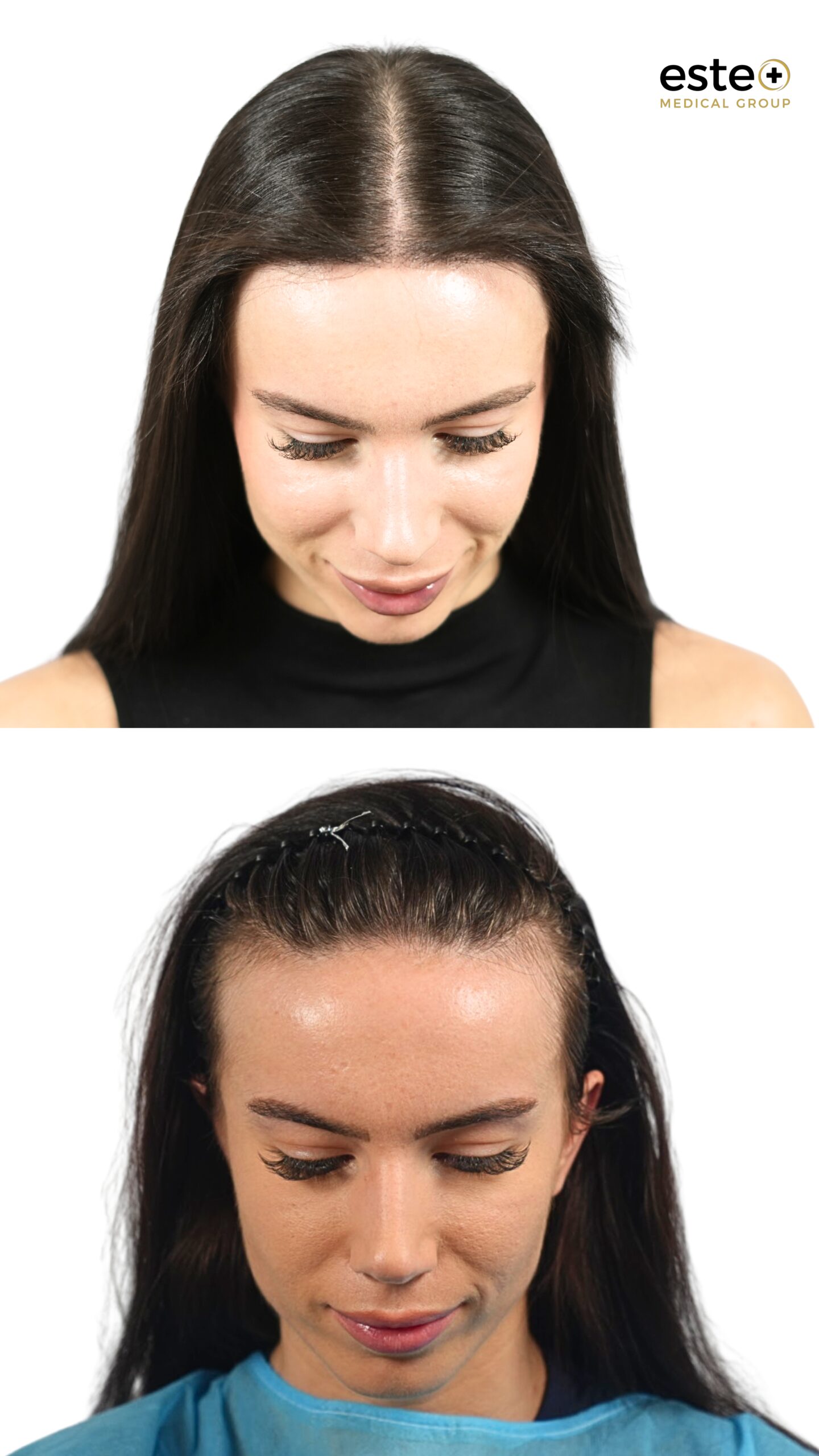DHI hair transplant before and after images showing fuller hair coverage