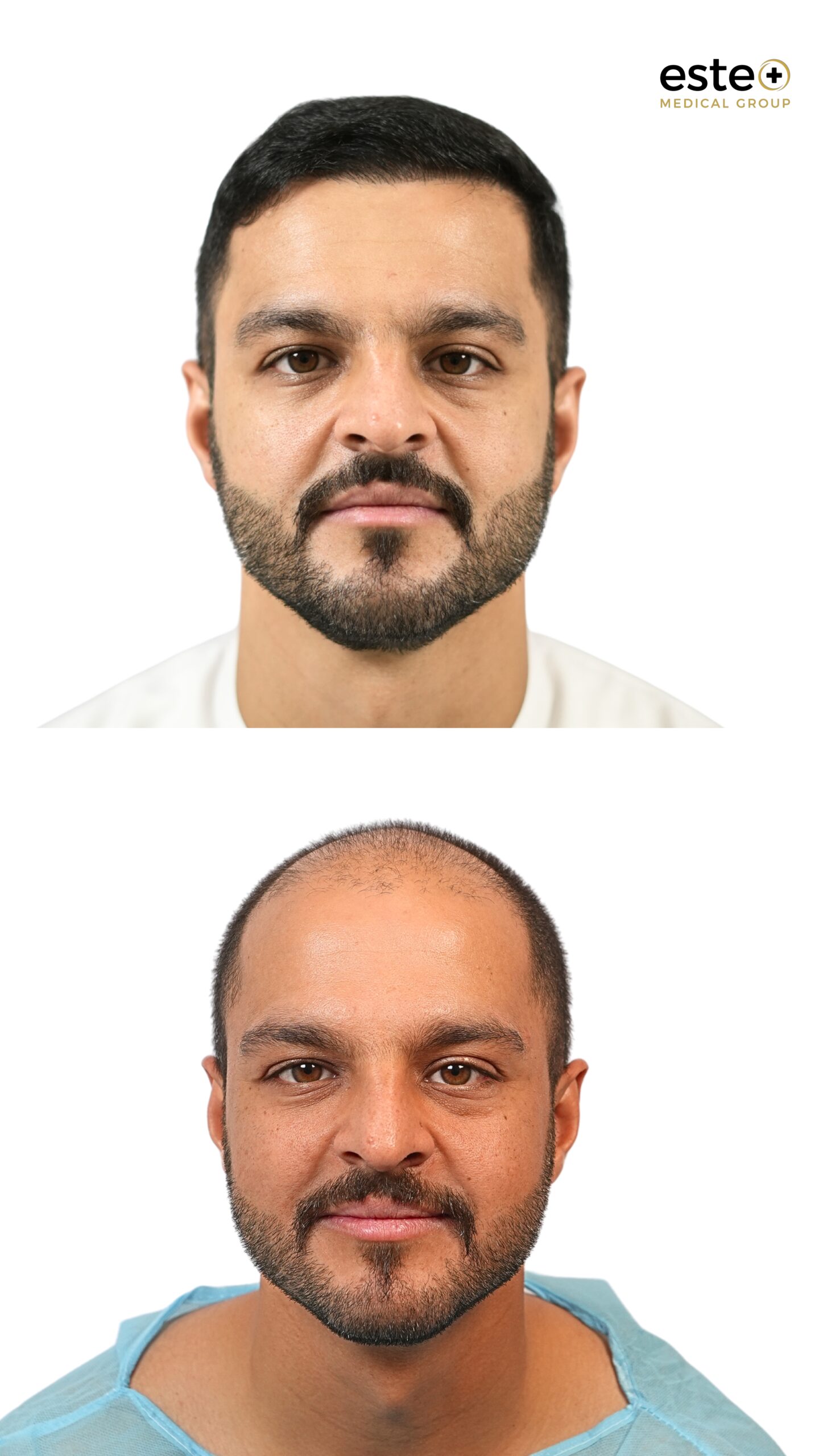 Hair transplant Dubai results for male hair loss treatment