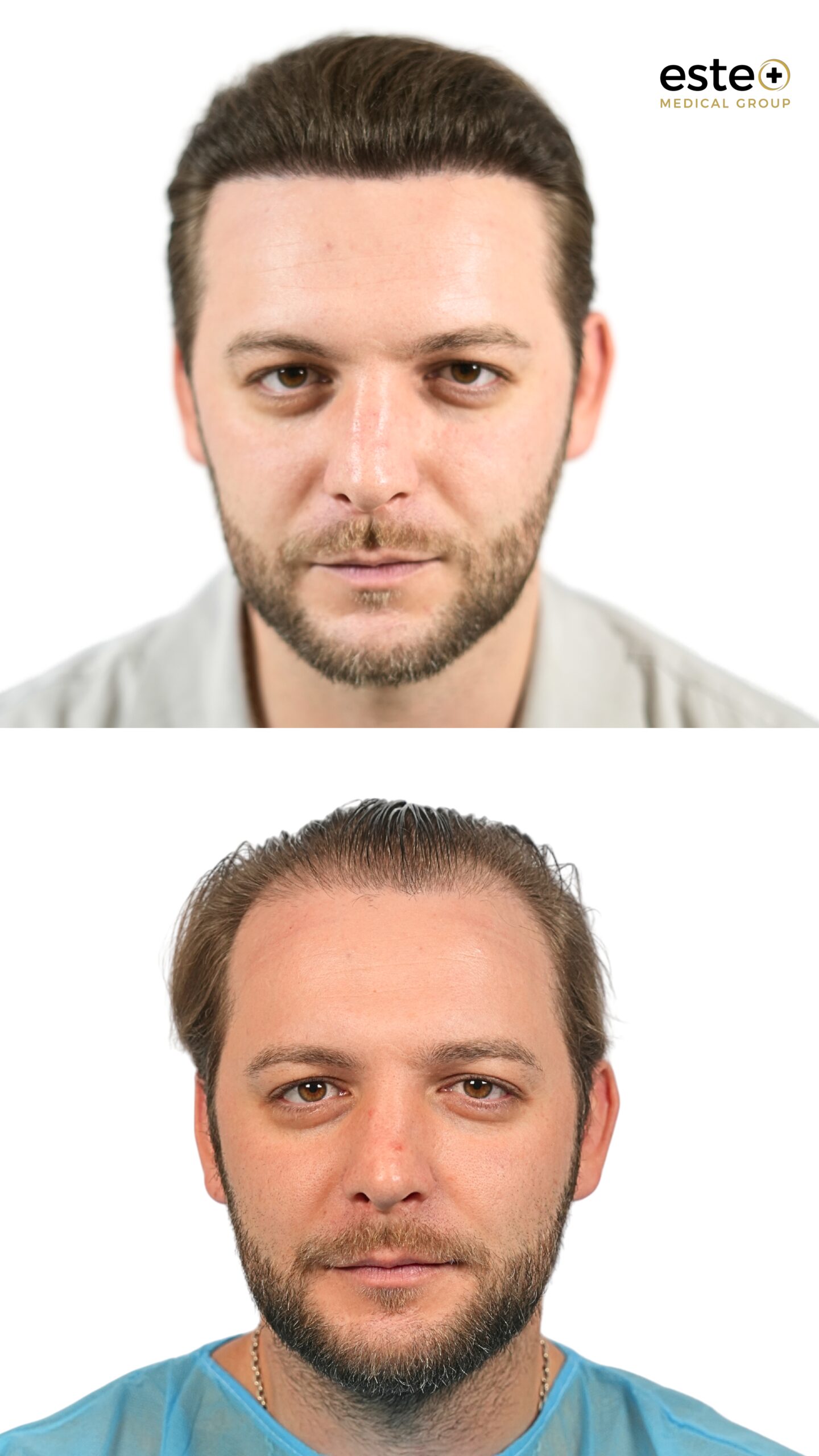 Natural looking hair transplant results before and after treatment in Dubai