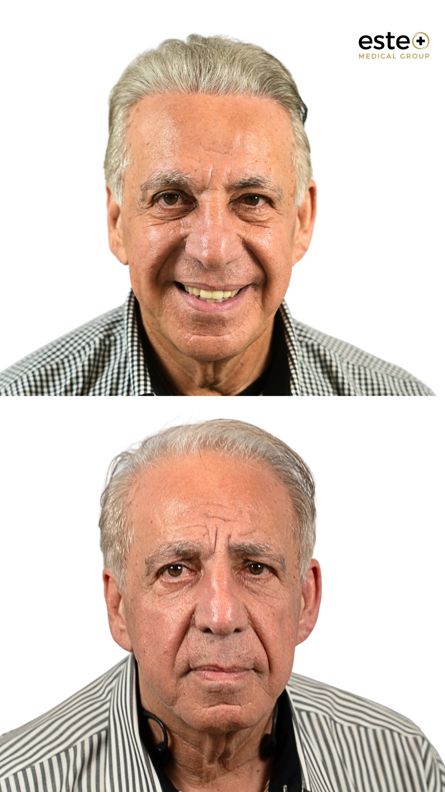 Before and after hair transplant for receding hairline at Este Medical Group Dubai