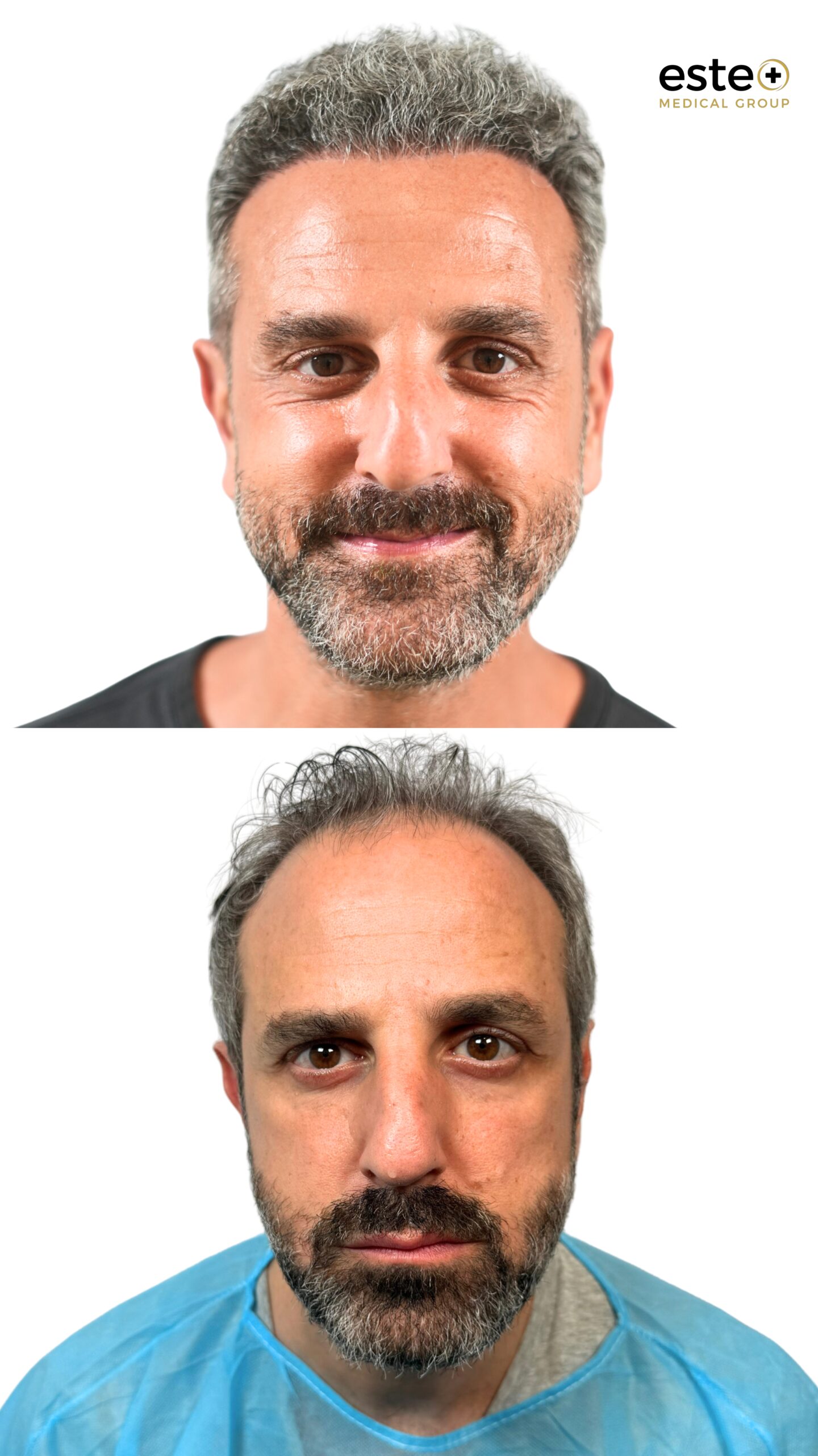 Receding hairline correction before and after hair transplant Dubai