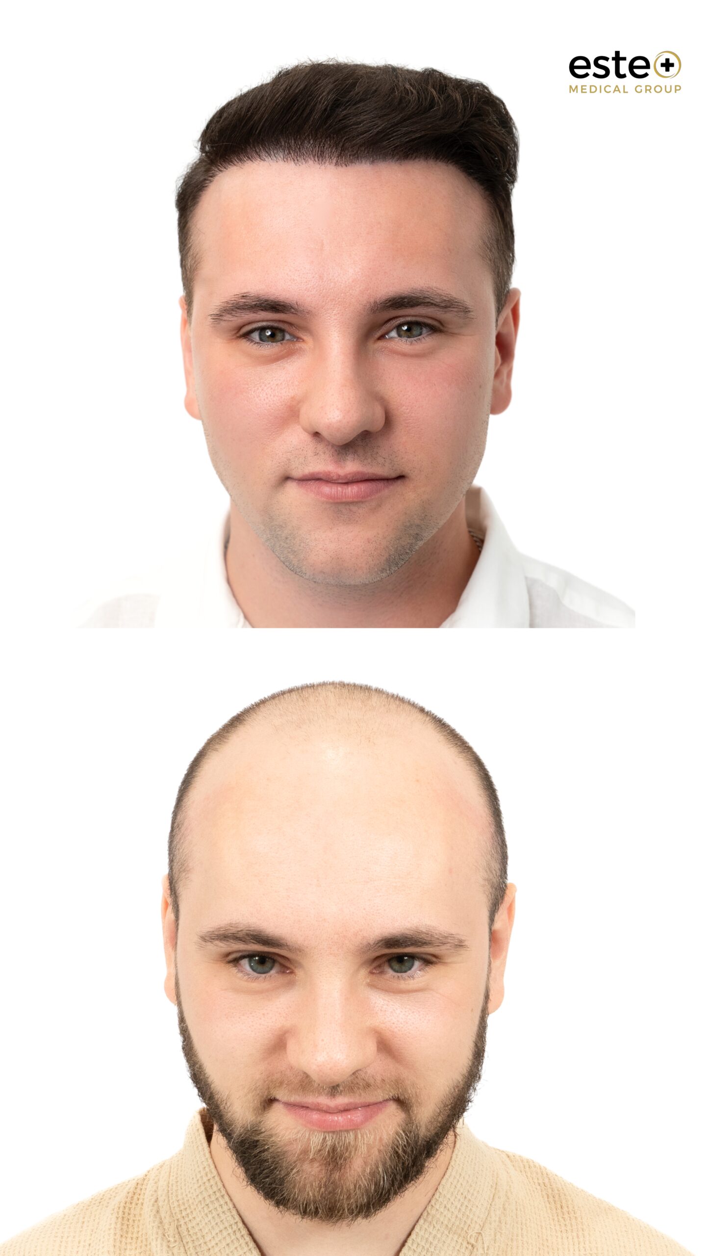 Male pattern baldness before and after DHI hair transplant in Dubai