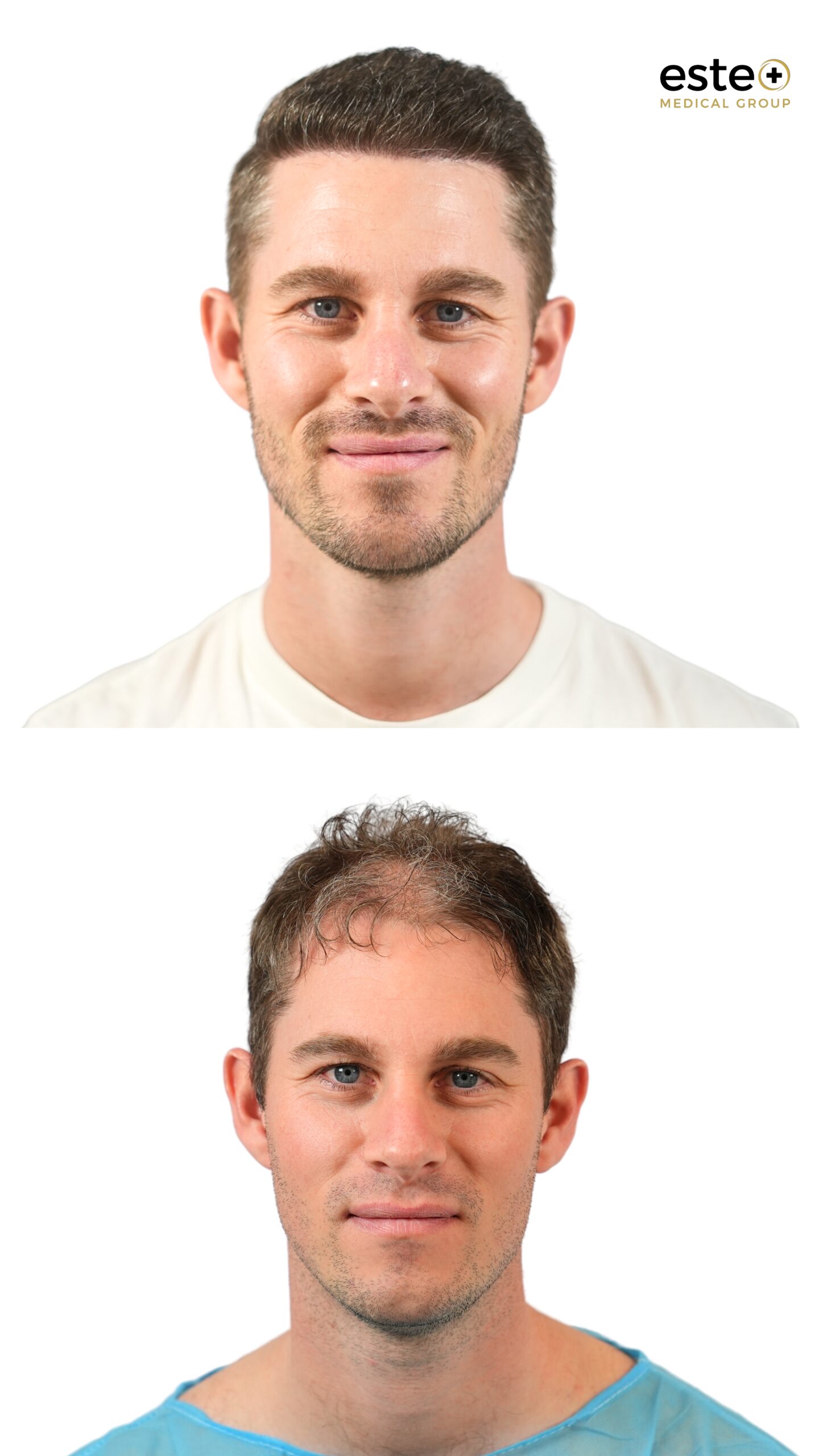 Receding hairline correction before and after hair transplant Dubai