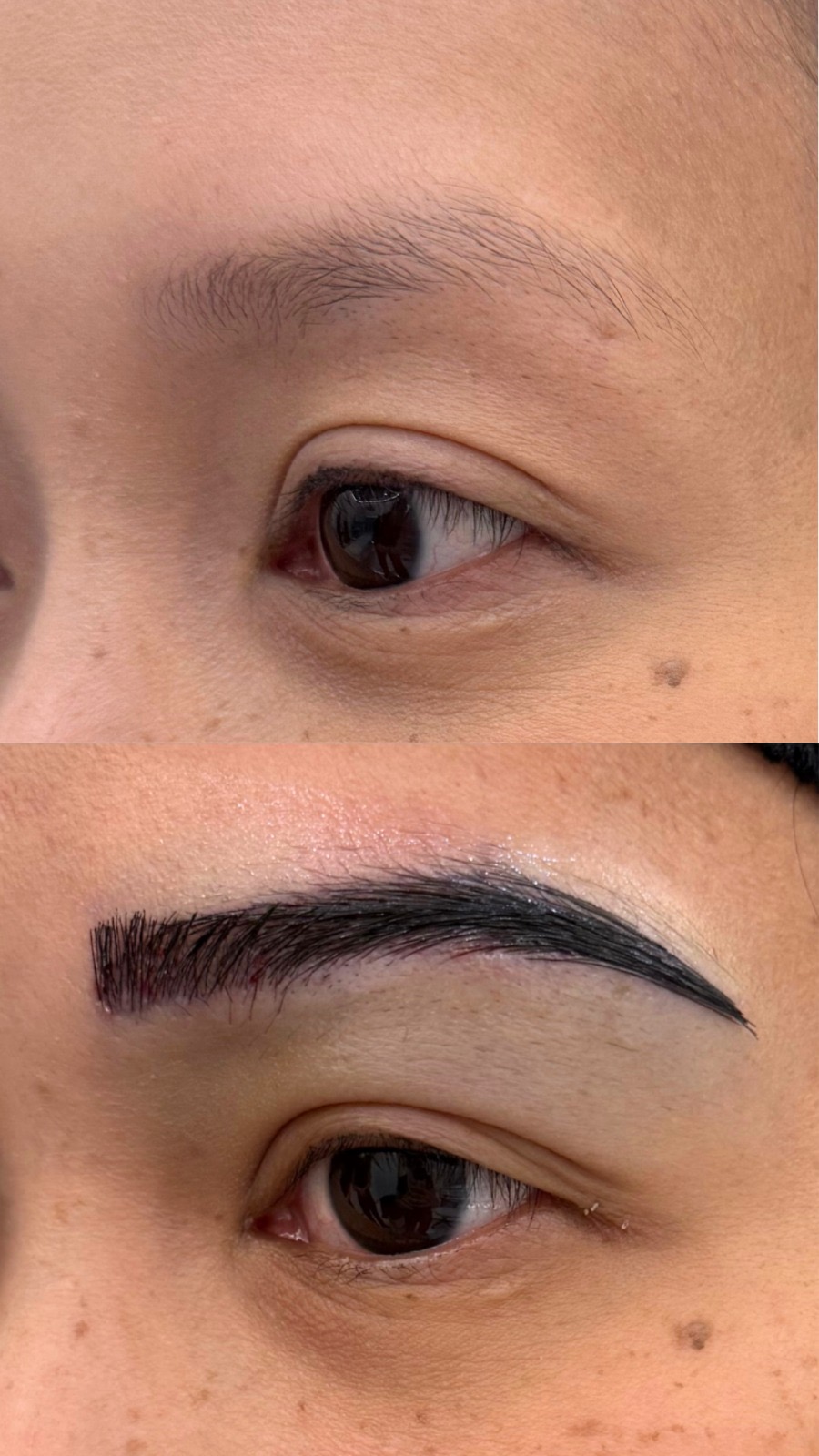 Eyebrow hair transplant before and after