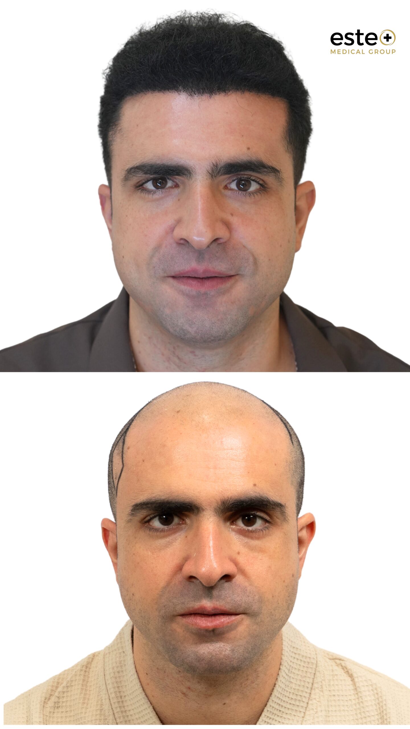 real hair transplant results dubai clinic