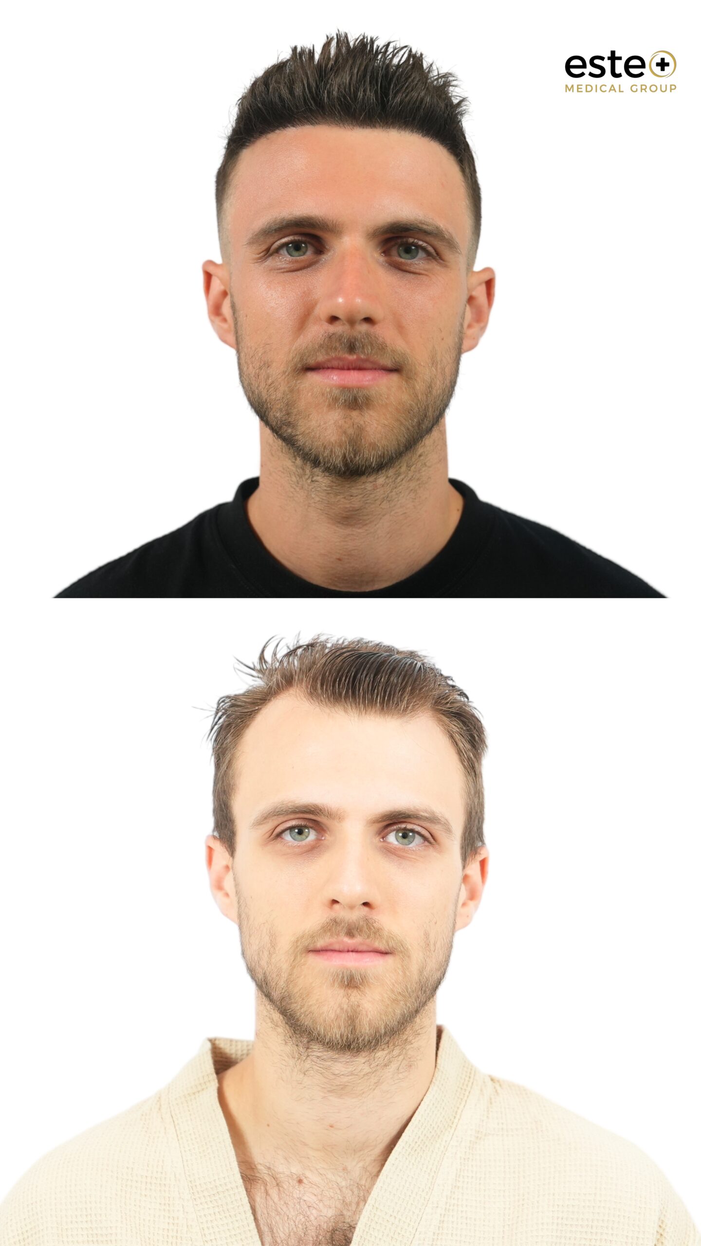 Hair transplant before and after results at Este Medical Group Dubai showing restored hairline