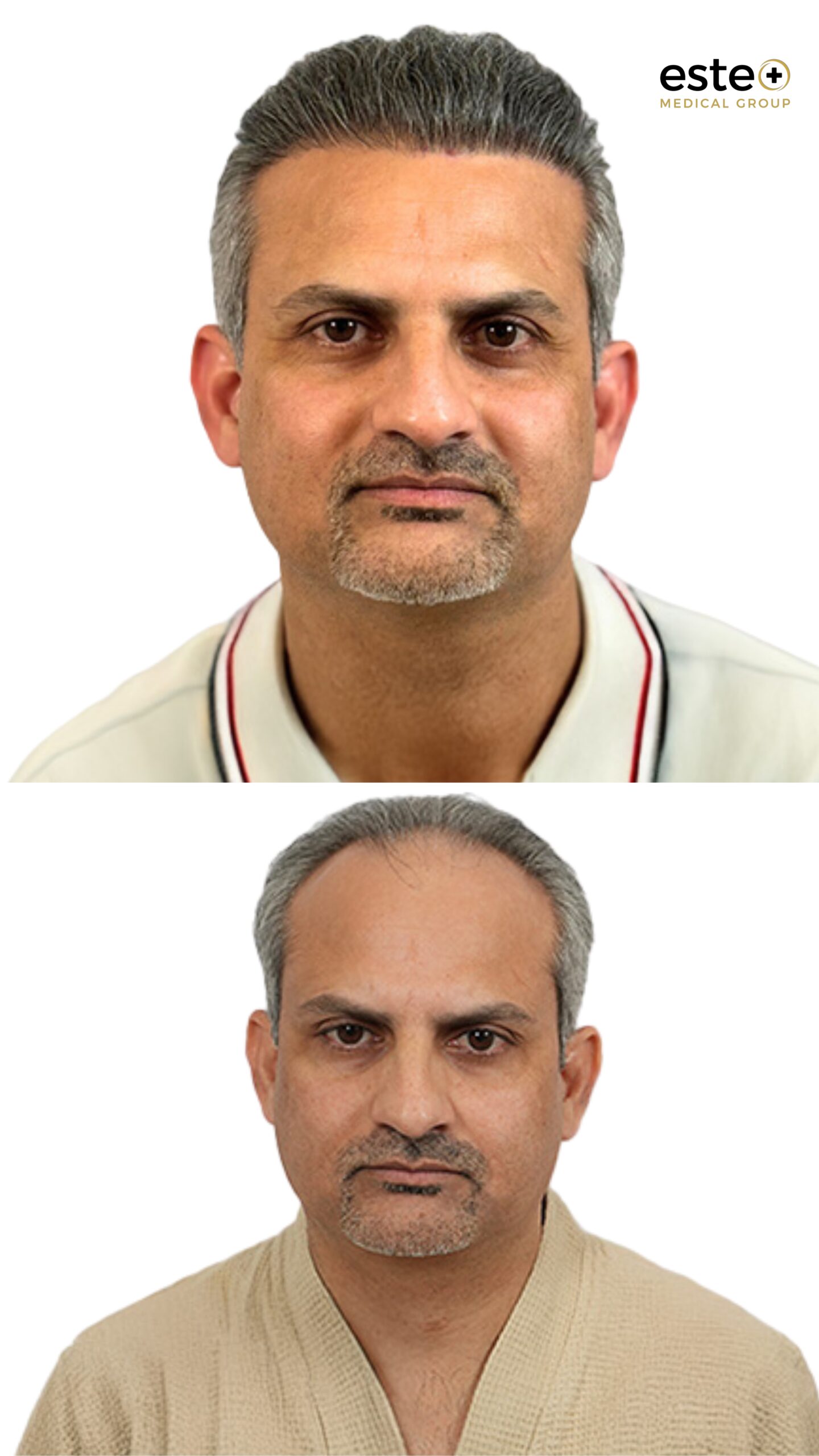 DHI hair transplant Dubai before and after patient results with improved hair density
