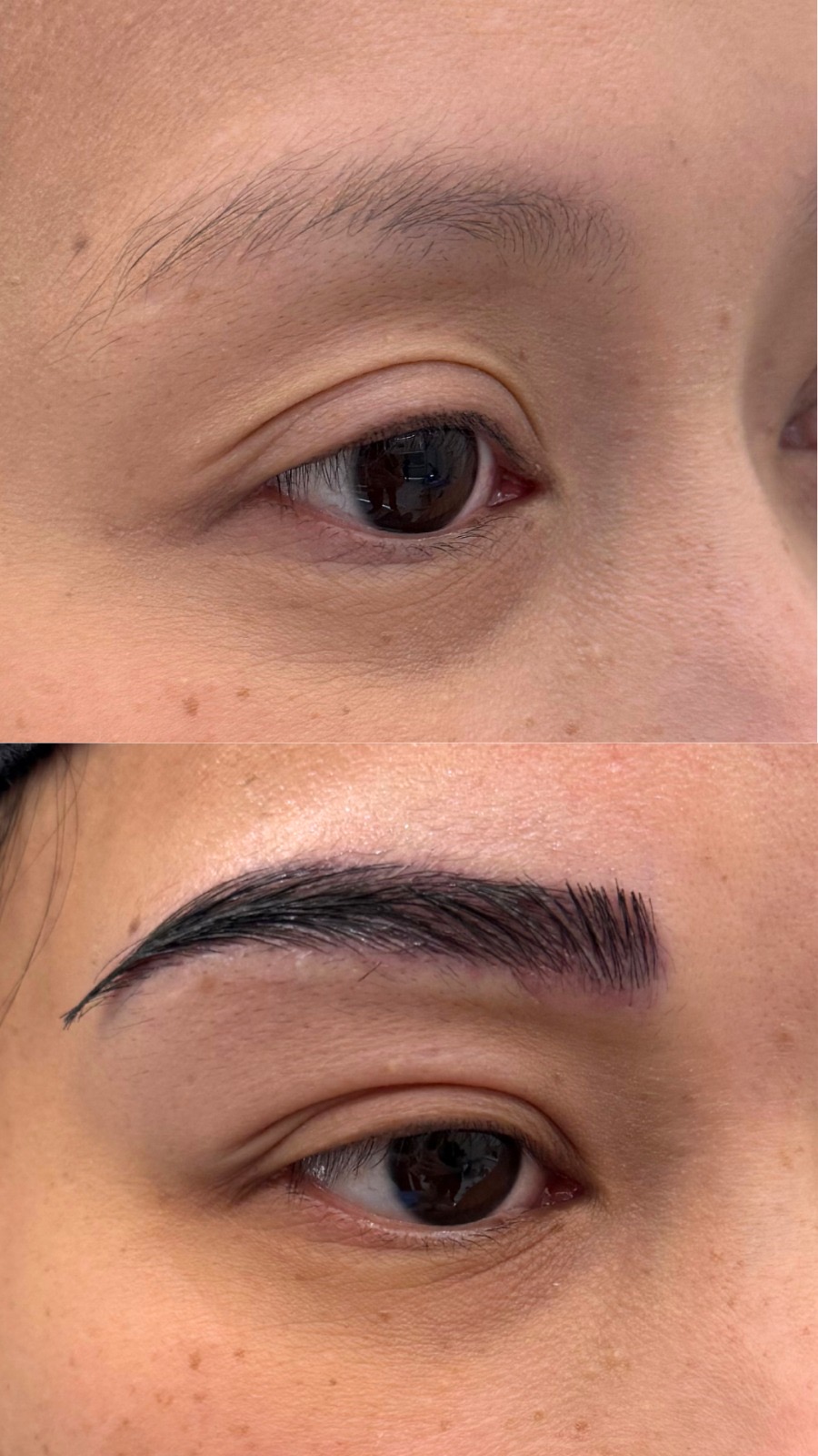 Eyebrow hair transplant before and after results