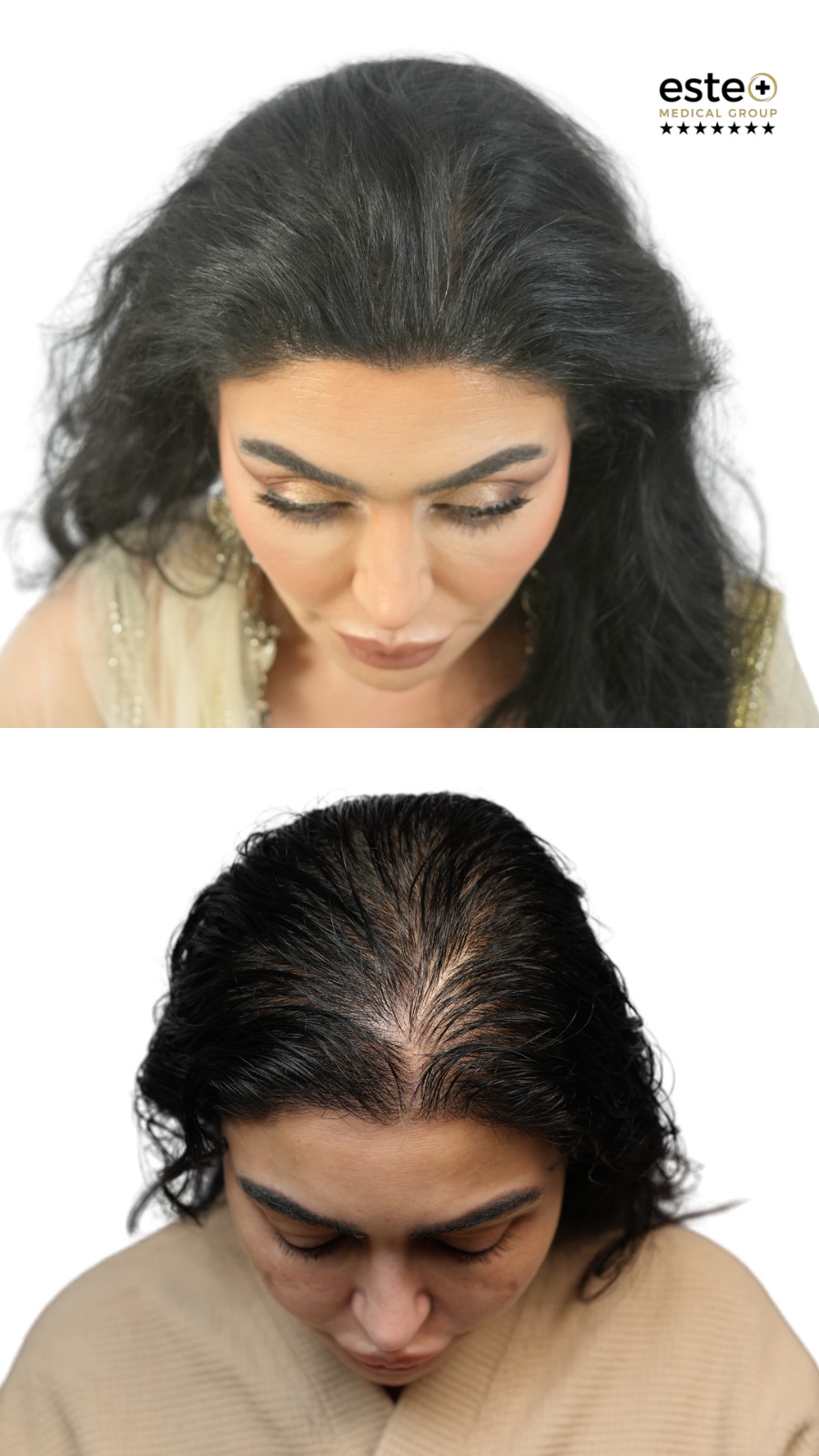 hair transplant crown restoration before after