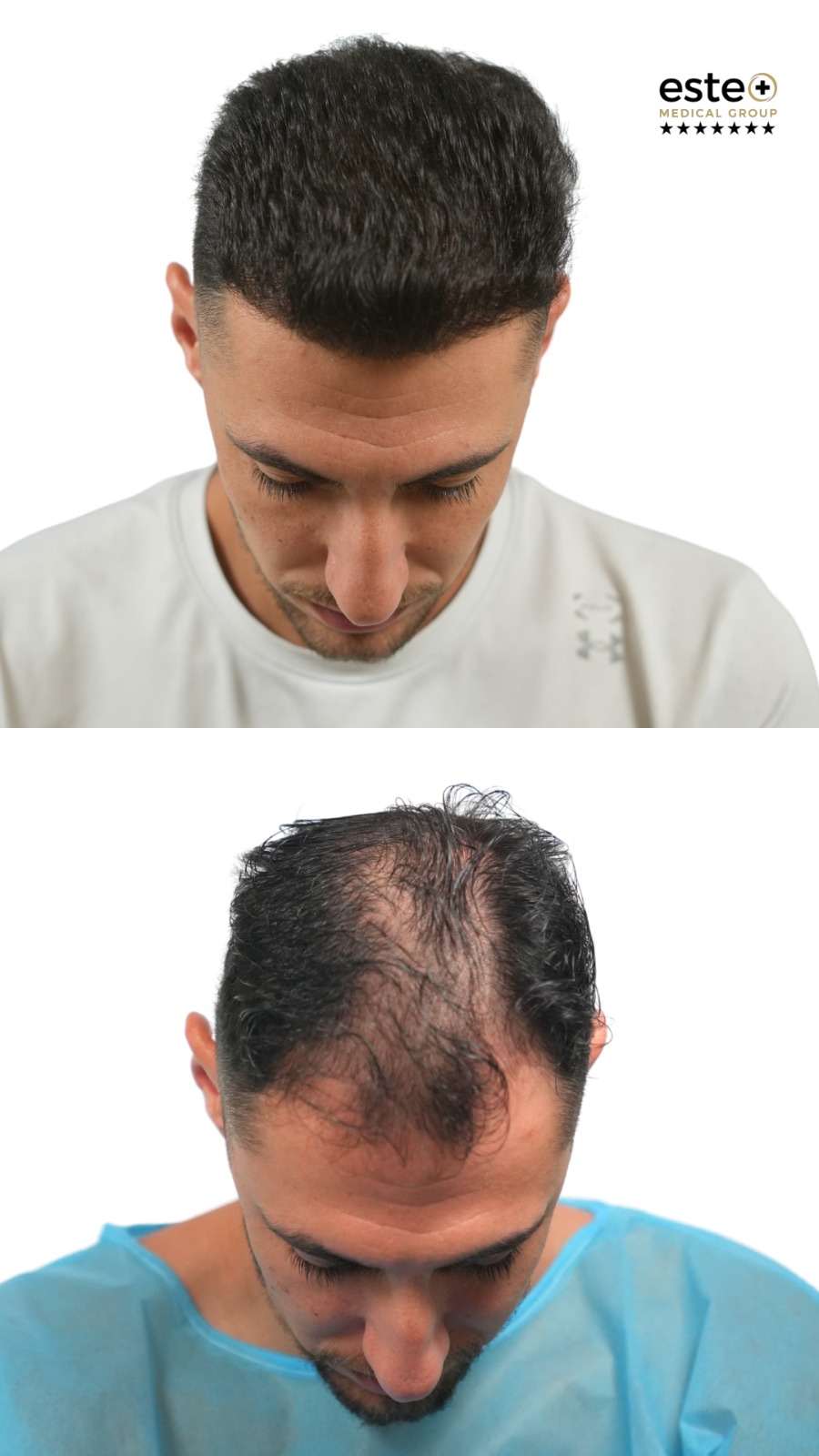 hairline restoration before after dubai