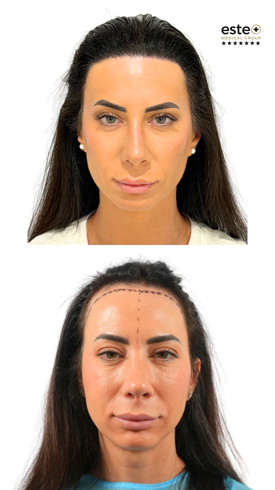 hair transplant before after results dubai