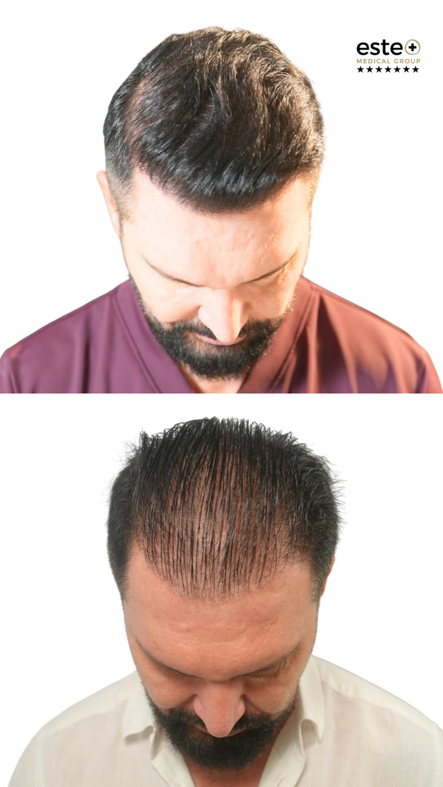 Natural hairline design after hair transplant treatment in Dubai clinic
