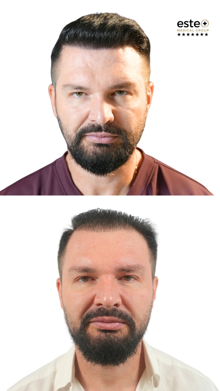 Natural looking hair transplant results before and after treatment in Dubai