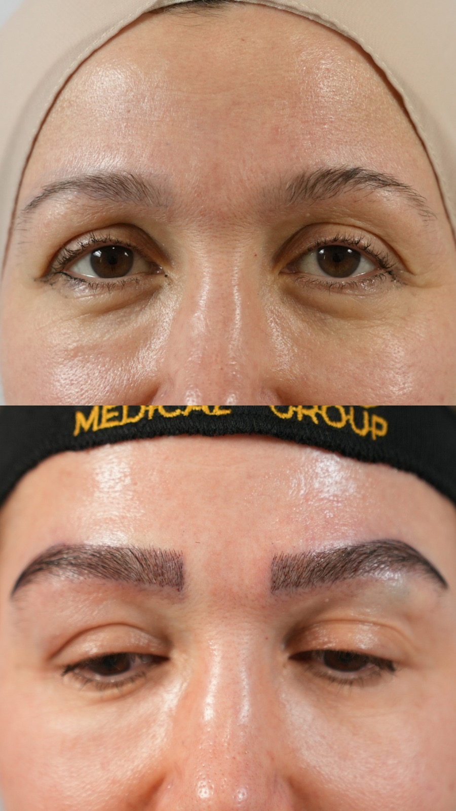 Eyebrow hair transplant before and after