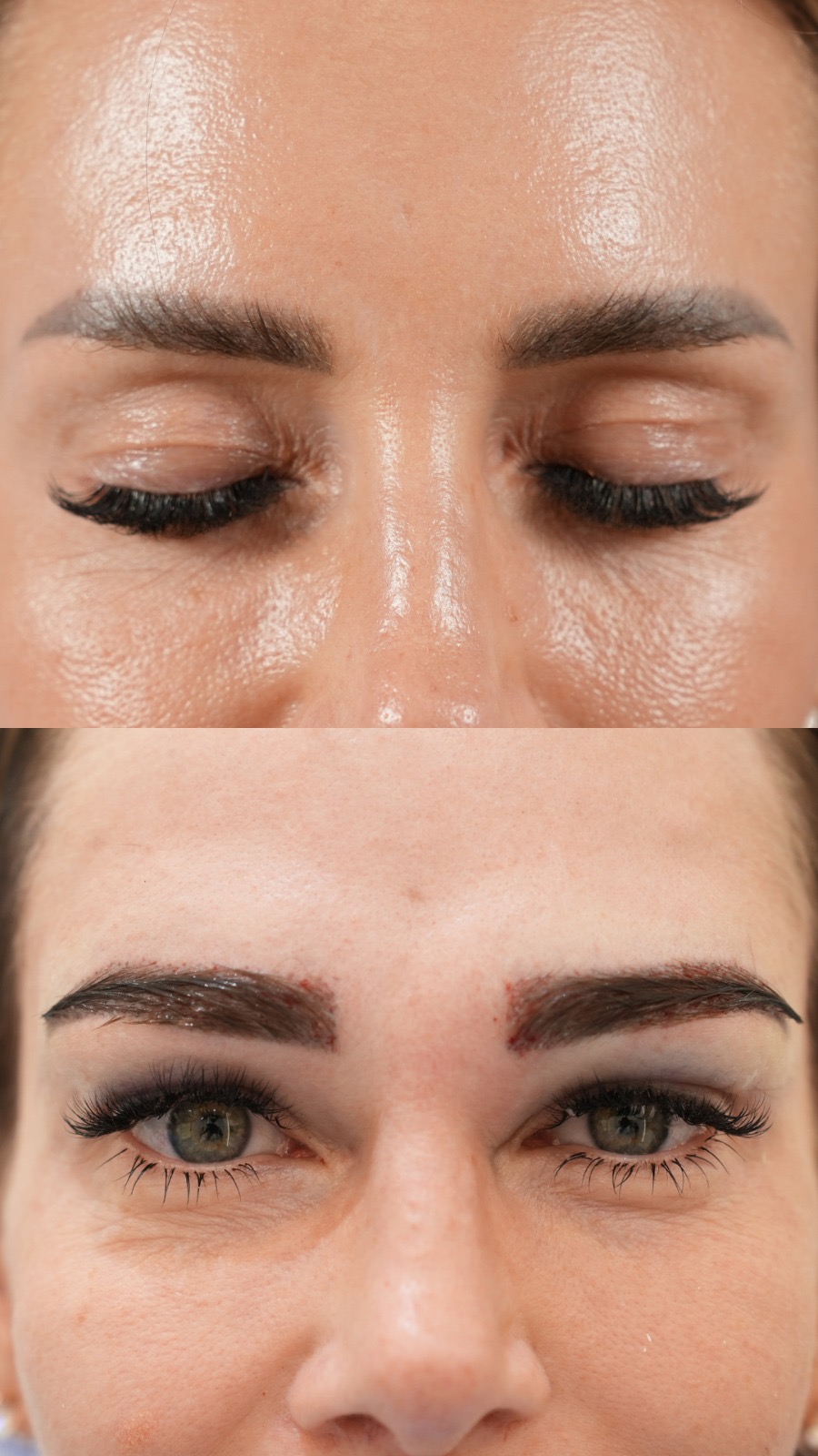 Eyebrow hair transplant before and after