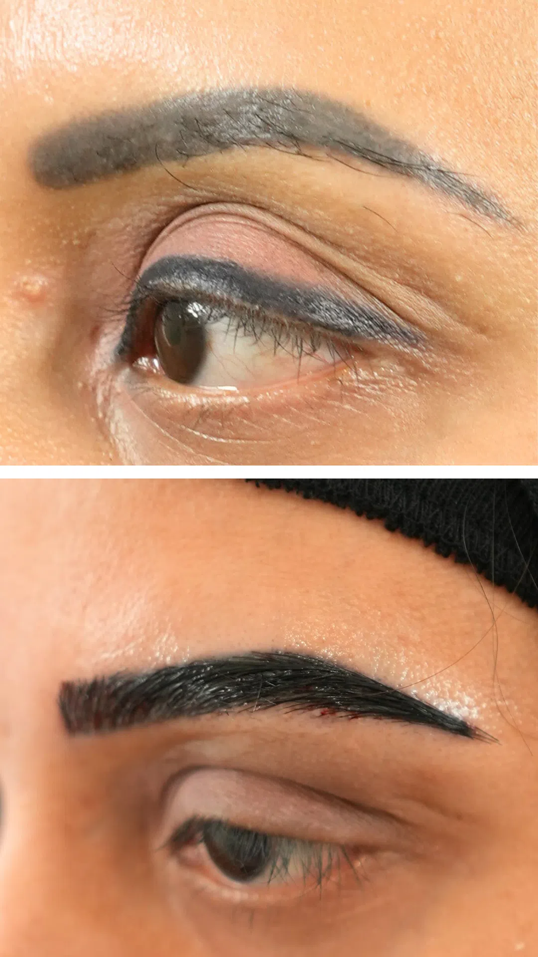 Eyebrow hair transplant before and after