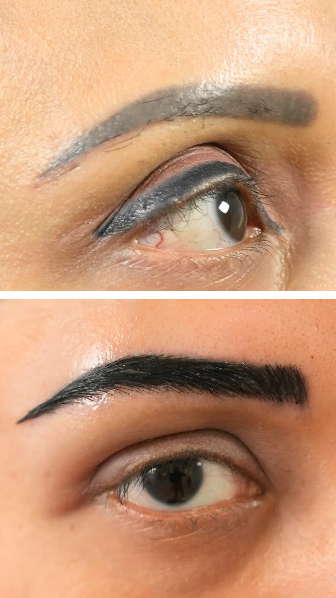 Eyebrow hair transplant before and after