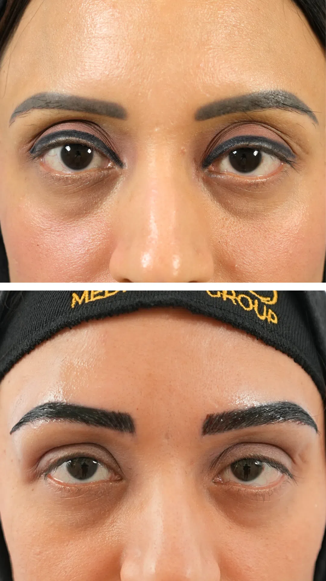 Eyebrow hair transplant before and after