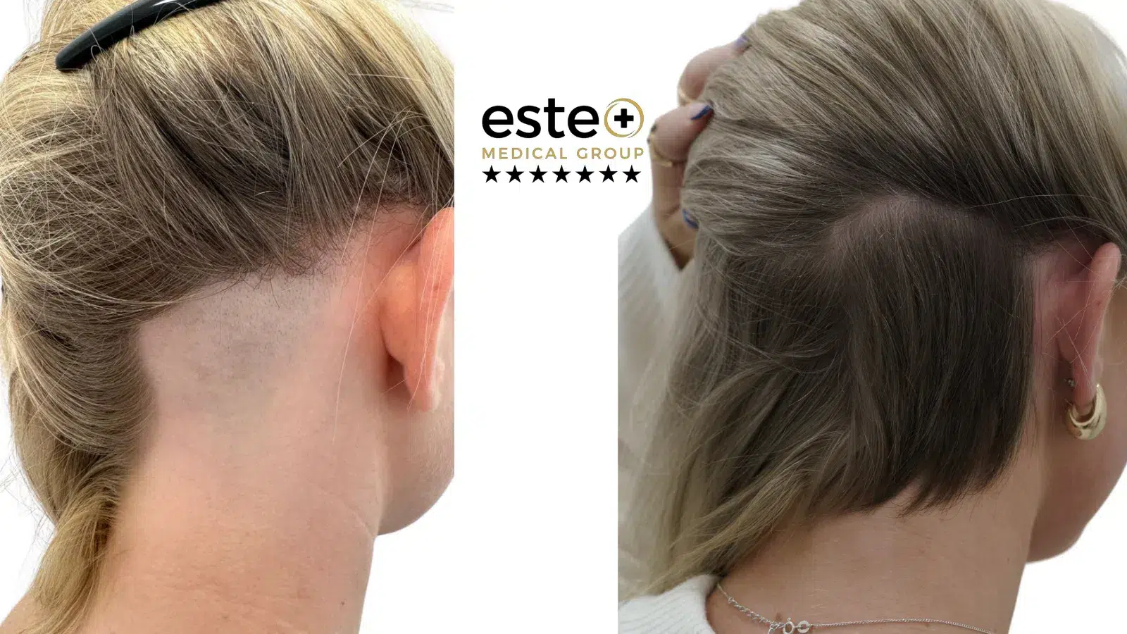 Alopecia treatment Before and After