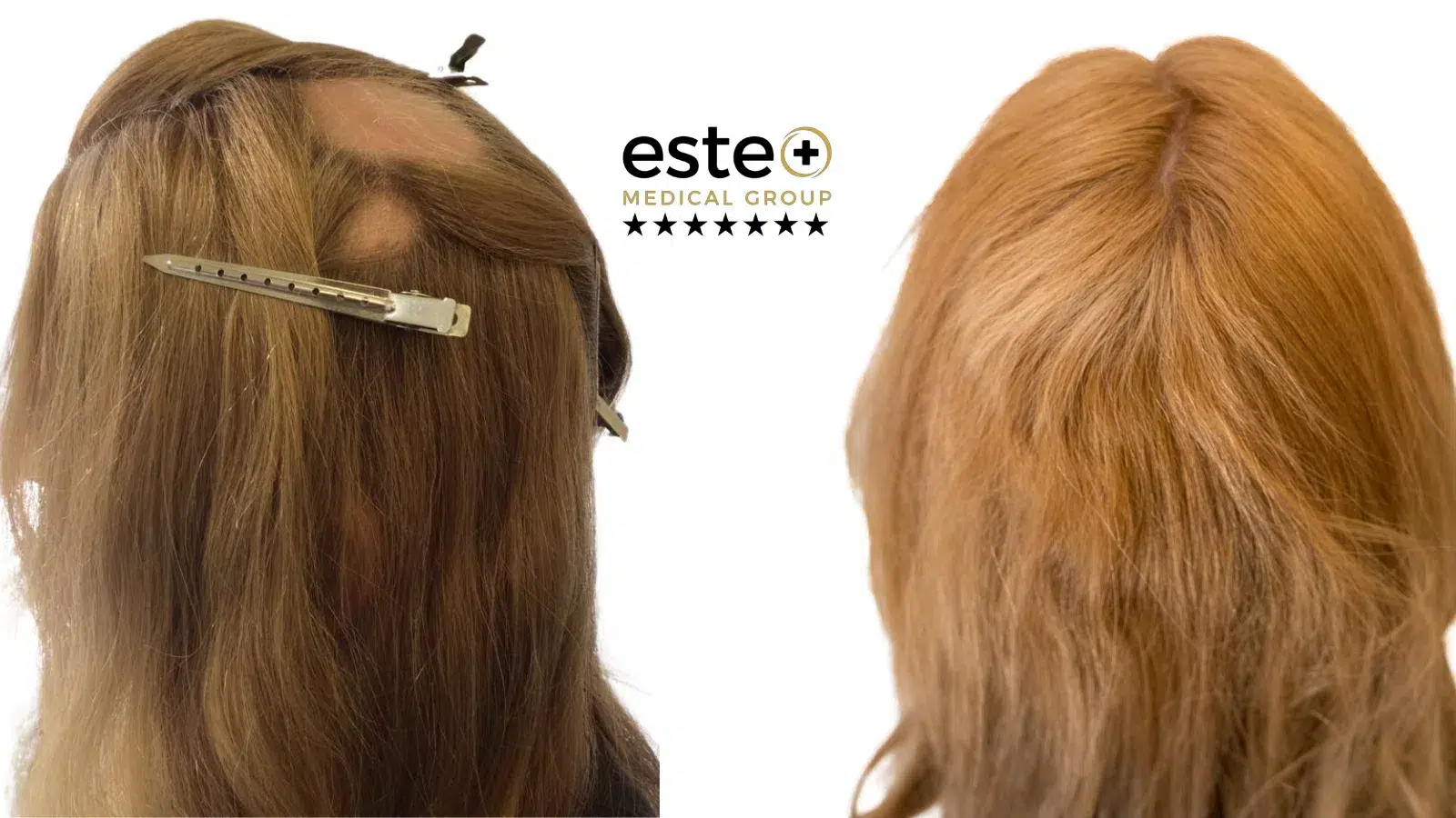 Alopecia Before and After results