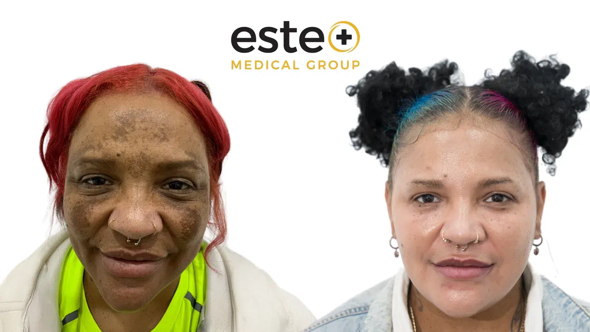 skin pigmentation before after dubai