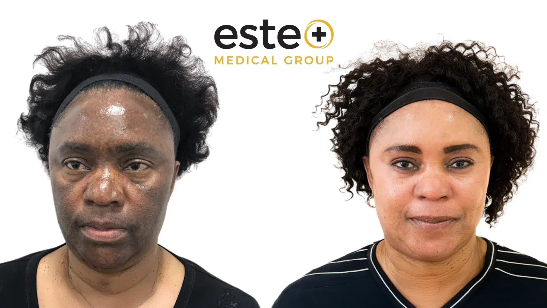 skin pigmentation before after results dubai