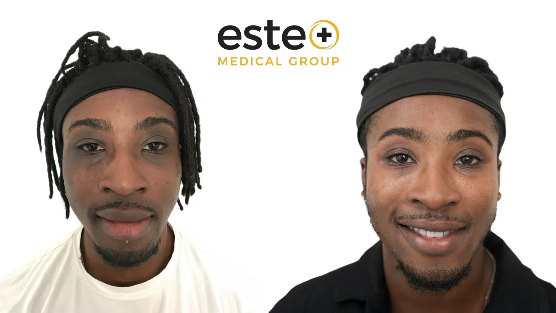 skin pigmentation before after