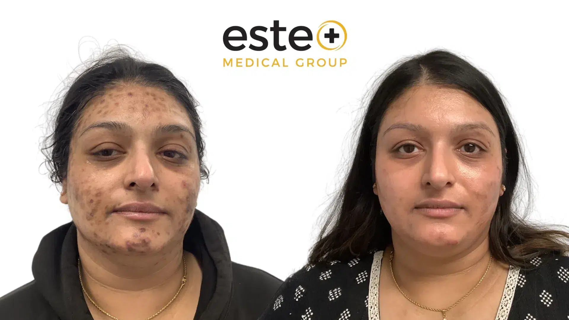 dark spots treatment results dubai