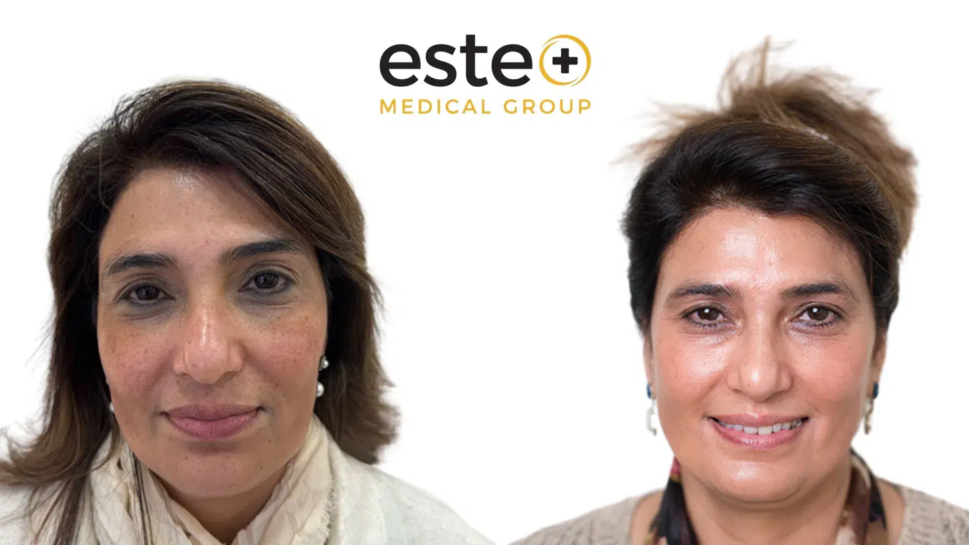 cosmelan pigmentation results dubai