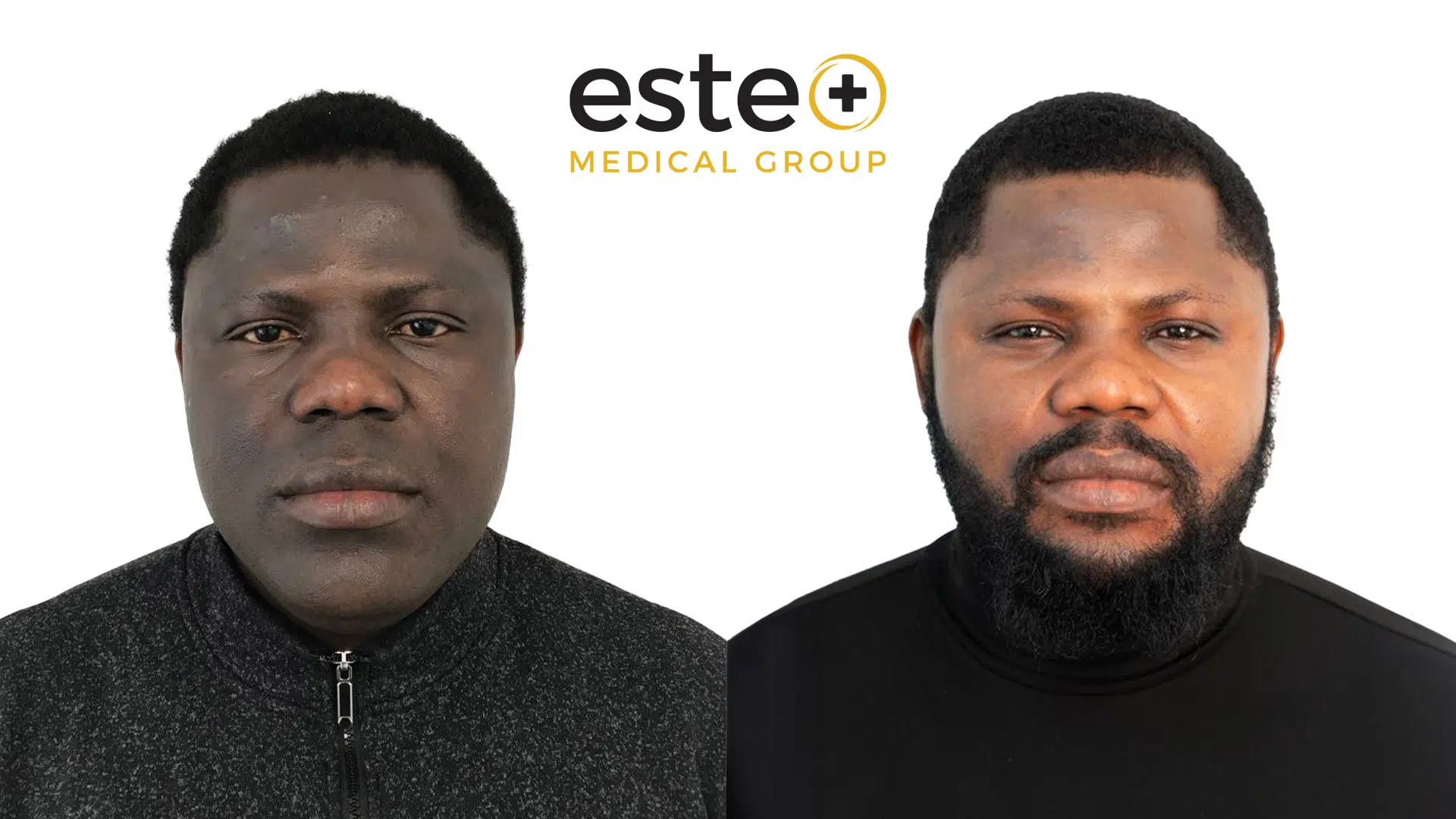 skin pigmentation before after dubai