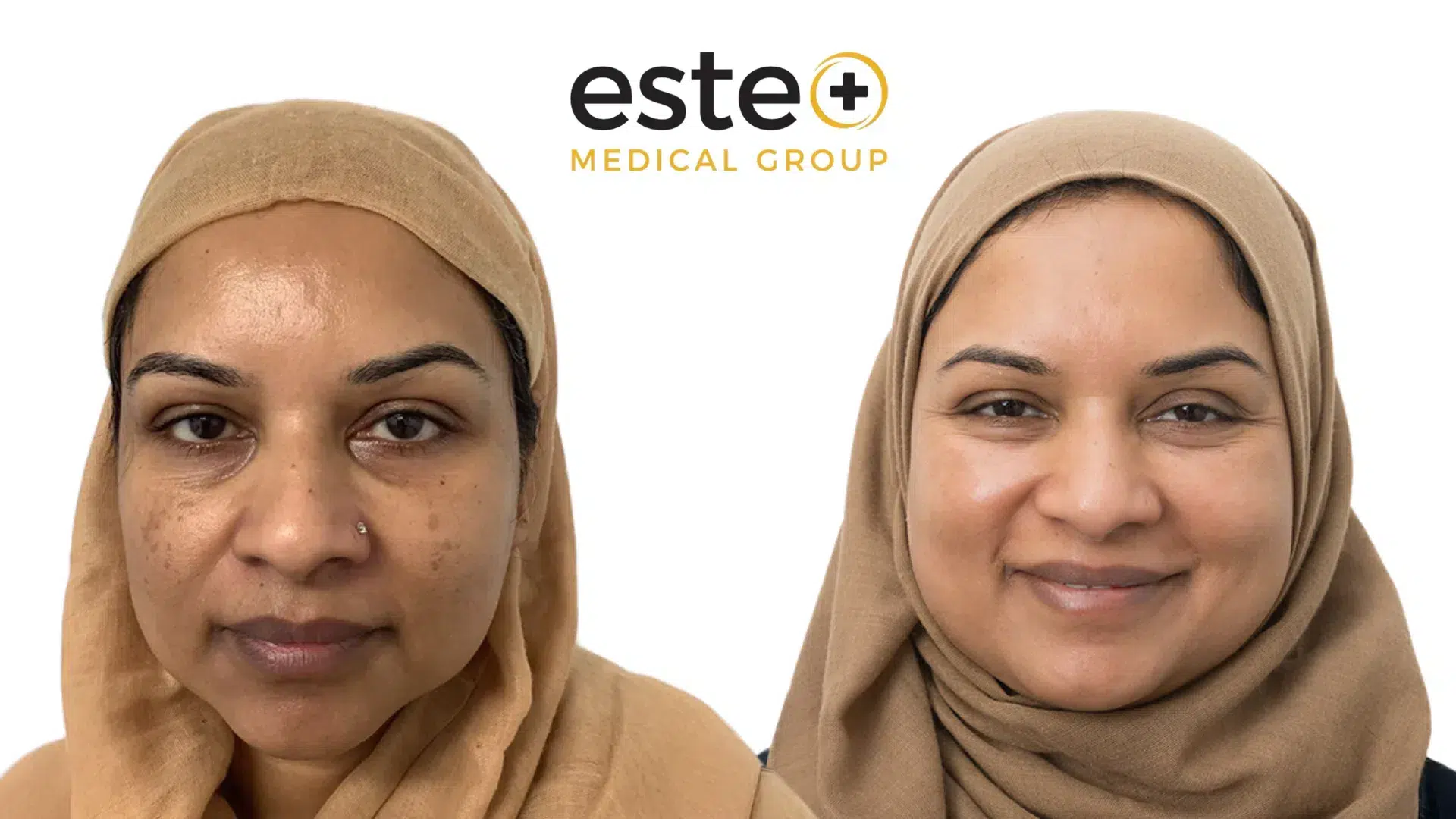 hyperpigmentation results dubai clinic
