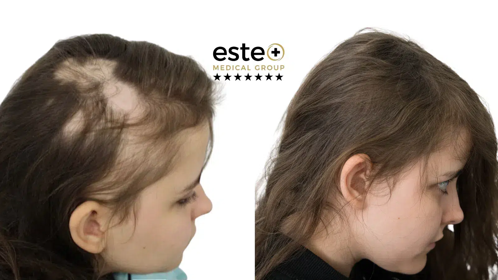 Alopecia Before and After