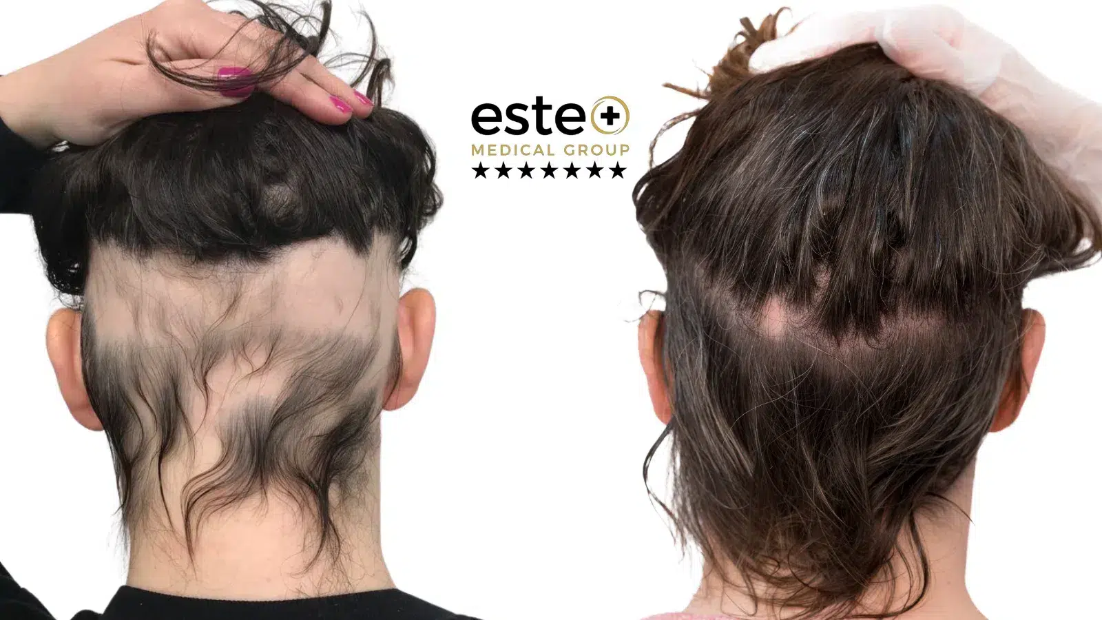 Alopecia treatment results