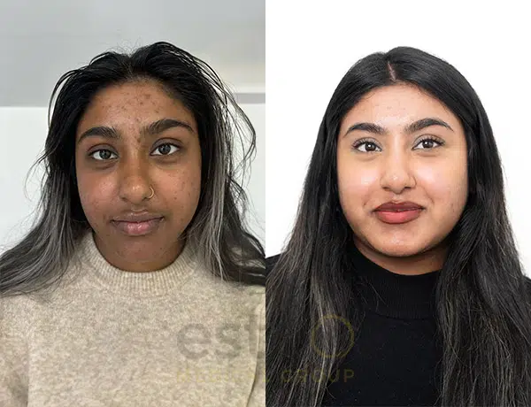 acne before after results dubai